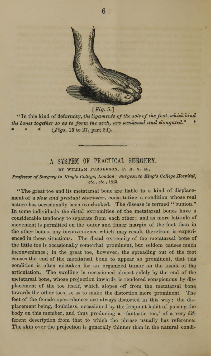 IFig. 5.]  In this kind of deformity, the ligaments of the sole of the foot, which hind the bones together so as to form the arch, a/re weakened and elongated. * ♦ * * {Figs. 15 to 27, part 2d). A SYSTEM OF PRACTICAL SURGERY. BY WILLIAM FCRGERSON, F. K. S. E., Professor of Surgery in King^s College, London; Surgeon to King's College Hospital, etc., etc., 1843. The great toe and its metatarsal bone are liable to a kind of displace- ment of a slow and gradual character, constituting a condition whose real nature has occasionally been overlooked. The disease is termed bunion. In some individuals the distal extremities of the metatarsal bones have a considerable tendency to separate from each other; and as more latitude of movement is permitted on the outer and inner margin of the foot than in the other bones, any inconvenience which may result therefrom is experi- enced in these situations. The distal extremity of the metatarsal bone of the little toe is occasionally somewliat prominent, but seldom causes much inconvenience; in the great toe, however, the spreading out of the foot causes the end of the metatarsal bone to appear so prominent, that this condition is often mistaken for an organized tumor on the inside of the articulation. The swelling is occasioned almost solely by the end of the metatarsal bone, whose projection inwards is rendered conspicuous by dis- placement of the toe itself, which slopes off from the metatarsal bone towards the other toes, so as to make the distortion more prominent. The feet of the female opera-dancer are always distorted in this way; the dis- placement being, doubtless, occasioned by the frequent habit of poising the body on this member, and thus producing a ' fantastic toe,' of a very dif- ferent description from that to which the phrase usually has reference. The skin over the projection is generally thinner than in the natural condi-