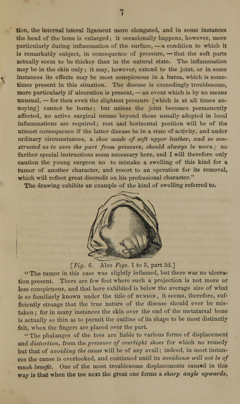 tion, the internal lateral ligament more elongated, and in some instances the head of the bone is enlarged; it occasionally happens, however, more particularly during inflammation of the surface,—a condition to -which it is remarkably subject, in consequence of pressure, — that the soft parts actually seem to be tliicker than in the natural state. The inflammation may be in the skin only; it may, however, extend to the joint, or in some instances its effects may be most conspicuous in a bursa, which is some- times present in this situation. The disease is exceedingly troublesome, more particularly if ulceration is present, — an event which is by no means unusual, — for then even the slightest pressure [which is at all times an- noying] cannot be borne; but unless the joint becomes permanently affected, no active surgical means beyond those usually adopted in local inflammations are required; rest and horizontal position will be of the utmost consequence if the latter disease be in a state of activity, and under ordinary circumstances, a shoe made of soft upper leather, and so con- structed as to save the part from pressure, should always be worn; no further special instructions seem necessary here, and I will therefore only caution the young surgeon no to mistake a swelling of this kind for a tumor of another character, and resort to an operation for its removal, which will reflect great discredit on his professional character. The drawing exhibits an example of the kind of swelling referred to. [Fig. 6. Also Figs. 1 to 5, part 2d.]  The tumor in this case was slightly inflamed, but there was no ulcera- tion present. There are few feet where such a projection is not more or less conspicuous, and that here exliibited is below the average size of what is so familiarly known under the title of bunion , it seems, therefore, suf- ficiently strange that the true nature of the disease should ever be mis- taken ; for in many instances the skin over the end of the metatarsal bone is actually so thin as to permit the outline of its shape to be most distinctly felt, when the fingers are placed over the part. The phalanges of the toes are liable to various forms of displacement and distortion, from the pressure of overtight shoes for which no remedy but that of avoiding the cause will be of any avail; indeed, in most instan- ces the cause is overlooked, and continued until its avoidance will not be of much benefit. One of the most troublesome displacements caused in this way is that when the toe next the great one forms a sharp angle upwards,