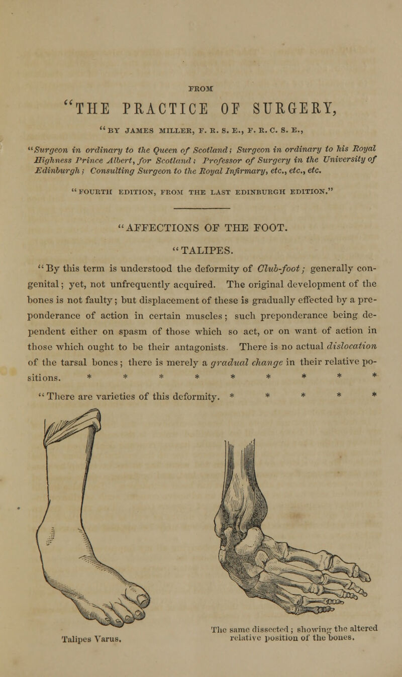 THE PRACTICE OE SURGERY,  BY JAMES MILLER, F. K. S. E., E. K. C. 8. E., Surgeon in ordinary to the Queen of Scotland; Surgeon in ordinary to his Royal Highness Prince Albert, for Scotland ; Professor of Surgery in the University of Edinburgh; Consulting Surgeon to the Boyal Infirmary, etc., etc, etc. FOURTH EDITION, FROM THE LAST EDINBURGH EDITION. AFFECTIONS OF THE FOOT.  TALIPES. By this term is understood the deformity of Club-foot; generally con- genital ; yet, not unfrequently acquired. The original development of the bones is not faulty; but displacement of these is gradually effected by a pre- ponderance of action in certain muscles; such preponderance being de- pendent either on spasm of those which so act, or on want of action in those which ought to be their antagonists. There is no actual dislocation of the tarsal bones ; there is merely a gradual change in their relative i)0- sitions. *********  There are varieties of this deformity. * * * * * Talipes Varus. Tlie same dissected ; showinjj the altered relative pusitioa of the boues.