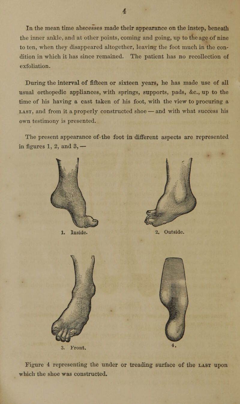 In the mean time abscesses made their appearance on the instep, beneath the inner ankle, and at other points, coining and going, up to the age of nine to ten, when they disappeared altogether, leaving the foot much in the con- dition in which it has since remained. The patient has no recollection of exfoliation. During the interval of fifteen or sixteen years, he has made use of all usual orthopedic appliances, with springs, supports, pads, &c., up to the time of his having a cast taken of his foot, with the view to procuring a LAST, and from it a properly constructed shoe — and with what success his own testimony is presented. The present appearance of-the foot in different aspects are represented in figures 1, 2, and 3, — luside. 2. Outside. Front. Figure 4 representing the under or treading surface of the last upon which the shoe was constructed.