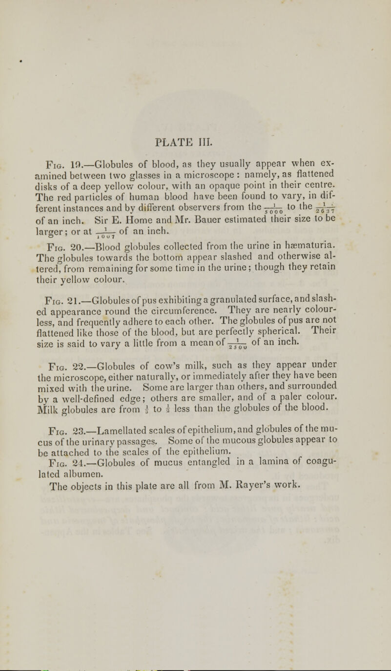 Fig. 19.—Globules of blood, as they usually appear when ex- amined between two glasses in a microscope : namely, as flattened disks of a deep yellow colour, with an opaque point in their centre. The red particles of human blood have been found to vary, in dif- ferent instances and by different observers from the j^-o to the —~^r of an inch. Sir E. Home and Mr. Bauer estimated their size to be larger; or at -i— of an inch. FIG. 20.—Blood globules collected from the urine in hematuria. The globules towards the bottom appear slashed and otherwise al- tered, from remaining for some time in the urine; though they retain their yellow colour. Fig. 21.—Globules of pus exhibitinga granulated surface, and slash- ed appearance round the circumference. They are nearly colour- less, and frequently adhere to each other. The globules of pus are not flattened like those of the blood, but are perfectly spherical. Their size is said to vary a little from a mean of ^^ of an inch. Fig. 22.—Globules of cow's milk, such as they appear under the microscope, either naturally, or immediately after they have been mixed with the urine. Some are larger than others, and surrounded by a well-defined edge; others are smaller, and of a paler colour. Milk globules are from Hoi less than the globules of the blood. Fig. 23.—Lamellated scales of epithelium, and globules of the mu- cus of the urinary passages. Some of the mucous globules appear to be attached to the scales of the epithelium. Fig. 24.—Globules of mucus entangled in a lamina of coagu- lated albumen. The objects in this plate are all from M. Rayer's work.