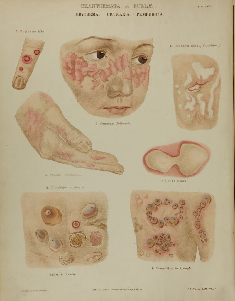 3 LLA KKYTHKMA. URTICARIA PEMPHIGUS \ ttn.'-mu Iris. o o \-. 'iiicaria alba • / Porcelain*. J 3. CommouL Urticaria. b*m4r' i 7. Lsurke Biul v •) • ***♦ o Bullnp & Crust* 6 . I'c'mpWft'iQ •«» J*r«mp%. fhifarf*Jf<h:.i, PubllS htJ by < JVZJ f //as I p.i iu,vcu, Lit* ijfm~