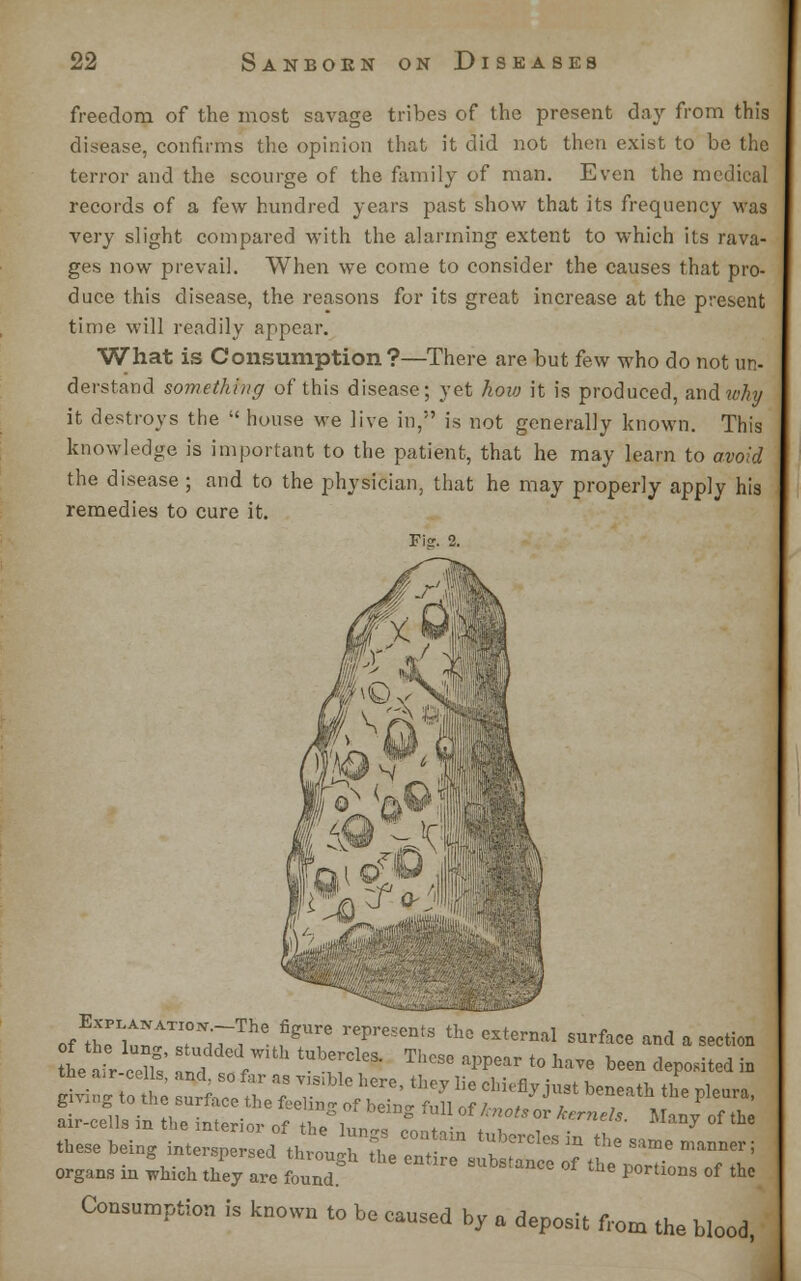 freedom of the most savage tribes of the present day from this disease, confirms the opinion that it did not then exist to be the terror and the scourge of the family of man. Even the medical records of a few hundred years past show that its frequency Mas very slight compared with the alarming extent to which its rava- ges now prevail. When we come to consider the causes that pro- duce this disease, the reasons for its great increase at the present time will readily appear. What is Consumption?—There are but few who do not un- derstand something of this disease; yet how it is produced, and why it destroys the  house we live in, is not generally known. This knowledge is important to the patient, that he may learn to avoid the disease ; and to the physician, that he may properly apply his remedies to cure it. Fi?. 2. IZ wTST?IT: rep,'eSentS th° GXternal Surface and * nation these being interspersed tliroJh tt I f '* m the s«me manner; organs in which they are found SUbStanC° ° ^ ^^ of the Consumption is known to be caused by a deposit from the blood,
