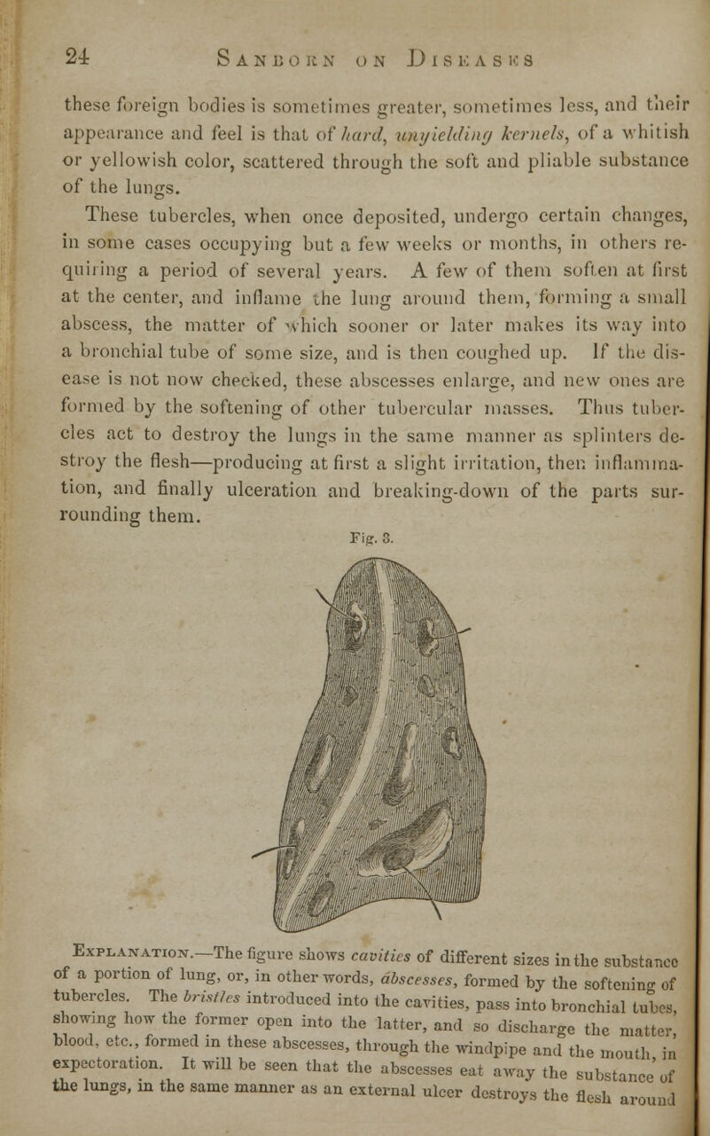 these foreign bodies is sometimes greater, sometimes less, and their appearance and feel is that of hard, unyielding kernels, of a whitish or yellowish color, scattered through the soft and pliable substance of the lungs. These tubercles, when once deposited, undergo certain changes, in some cases occupying but a few weeks or months, in others re- quiring a period of several years. A few of them soften at fust at the center, and inflame the lung around them, forming a small abscess, the matter of which sooner or later makes its way into a bronchial tube of some size, and is then coughed up. If the dis- ease is not now checked, these abscesses enlarge, and new ones are formed by the softening of other tubercular masses. Thus tuber- cles act to destroy the lungs in the same manner as splinters de- stroy the flesh—producing at first a slight irritation, then inflamma- tion, and finally ulceration and breaking-down of the parts sur- rounding them. Fig. s. ExPLANAxjox.-The figure shows cavities of different sizes in the substance of a portion of lung, or, in other words, abscesses, formed by the softening of tubercles. The bristles introduced into the cavities, pass into bronchial tubes, showing how the former open into the latter, and so discharge the matter blood, etc., formed in these abscesses, through the windpipe and the mouth in expectoration It will be seen that the abscesses eat away the substance'of the lungs, in the same manner as an external ulcer destroys the flesh around