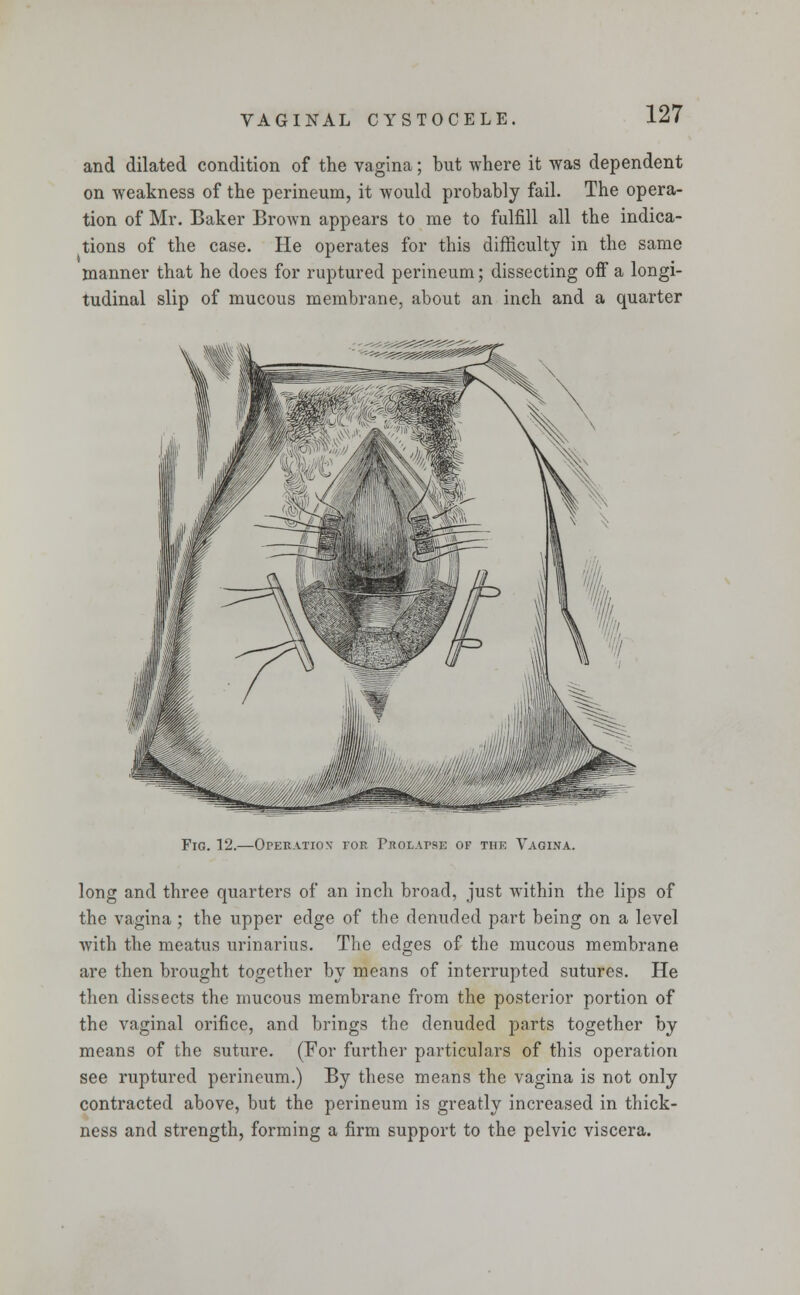 and dilated condition of the vagina; but where it was dependent on weakness of the perineum, it would probably fail. The opera- tion of Mr. Baker Brown appears to me to fulfill all the indica- tions of the case. He operates for this difficulty in the same manner that he does for ruptured perineum; dissecting off a longi- tudinal slip of mucous membrane, about an inch and a quarter Fig. 12.—Operation for Prolapse of the Vagina. long and three quarters of an inch broad, just within the lips of the vagina ; the upper edge of the denuded part being on a level with the meatus urinarius. The edges of the mucous membrane are then brought together by means of interrupted sutures. He then dissects the mucous membrane from the posterior portion of the vaginal orifice, and brings the denuded parts together by means of the suture. (For further particulars of this operation see ruptured perineum.) By these means the vagina is not only contracted above, but the perineum is greatly increased in thick- ness and strength, forming a firm support to the pelvic viscera.