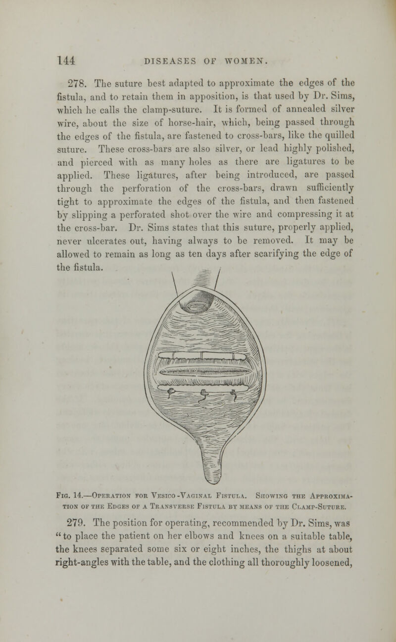 278. The suture best adapted to approximate the edges of the fistula, and to retain them in apposition, is that used by Dr. Sims, which he calls the clamp-suture. It is formed of annealed silver wire, about the size of horse-hair, which, being passed through the edges of the fistula, are fastened to cross-bars, like the quilled suture. These cross-bars are also silver, or lead highly polished, and pierced with as many holes as there are ligatures to be applied. These ligatures, after being introduced, are passed through the perforation of the cross-bars, drawn sufficiently tight to approximate the edges of the fistula, and then fastened by slipping a perforated shot over the wire and compressing it at the cross-bar. Dr. Sims states that this suture, properly applied, never ulcerates out, having always to be removed. It may be allowed to remain as long as ten days after scarifying the edge of the fistula. Fig. 14.—Operation for Vesico -Vaginae Fistula. Showing the Approxima- tion or the Edges of a Transverse Fistula by means of the Clamp-Suture. 279. The position for operating, recommended by Dr. Sims, was  to place the patient on her elbows and knees on a suitable table, the knees separated some six or eight inches, the thighs at about right-angles with the table, and the clothing all thoroughly loosened,