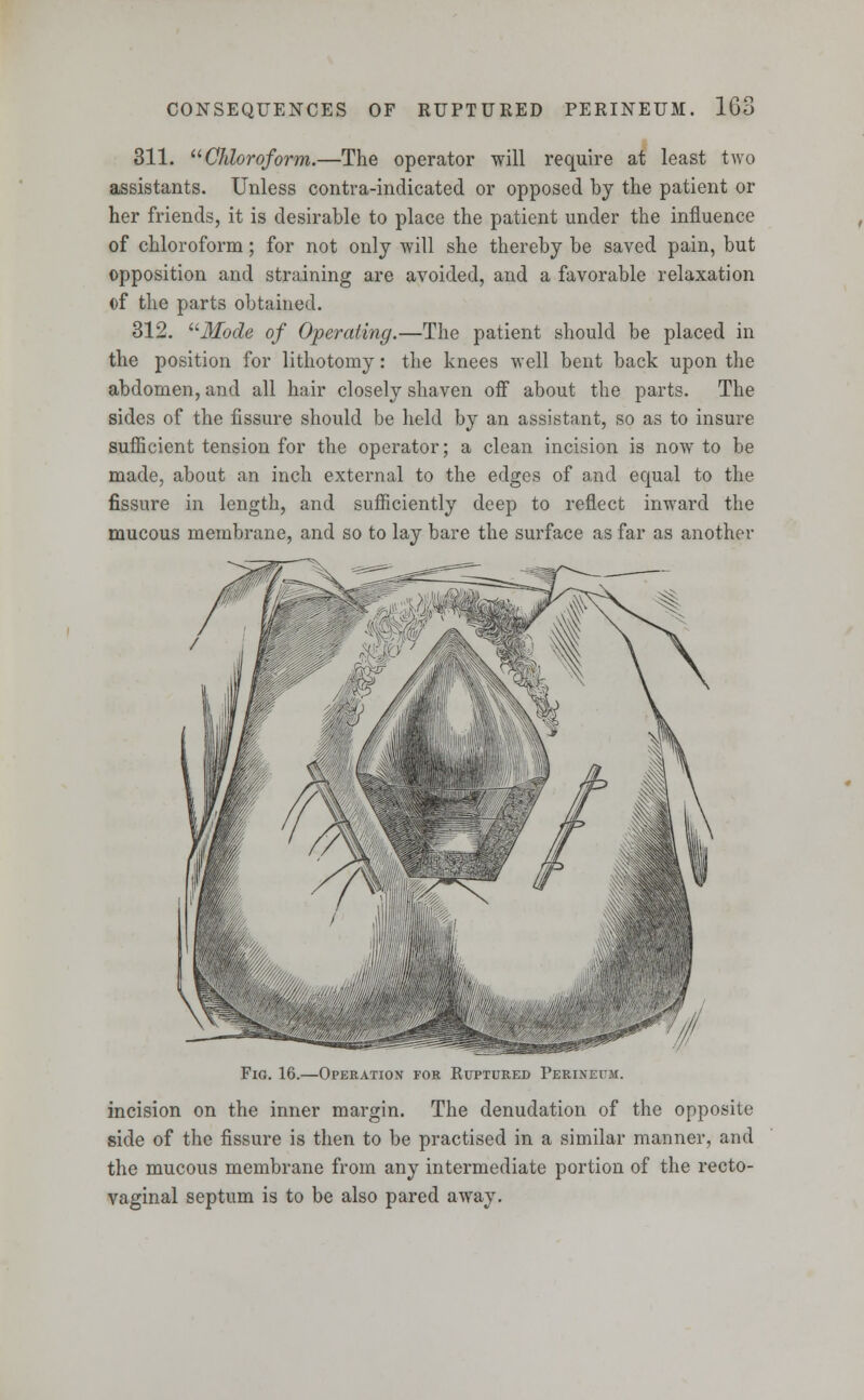 311. Chloroform.—The operator will require at least two assistants. Unless contra-indicated or opposed by the patient or her friends, it is desirable to place the patient under the influence of chloroform; for not only will she thereby be saved pain, but opposition and straining are avoided, and a favorable relaxation of the parts obtained. 312. Mode of Operating.—The patient should be placed in the position for lithotomy: the knees well bent back upon the abdomen, and all hair closely shaven off about the parts. The sides of the fissure should be held by an assistant, so as to insure sufficient tension for the operator; a clean incision is now to be made, about an inch external to the edges of and equal to the fissure in length, and sufficiently deep to reflect inward the mucous membrane, and so to lay bare the surface as far as another Fig. 16.—Operation for Ruptured Perineum. incision on the inner margin. The denudation of the opposite side of the fissure is then to be practised in a similar manner, and the mucous membrane from any intermediate portion of the recto- vaginal septum is to be also pared away.