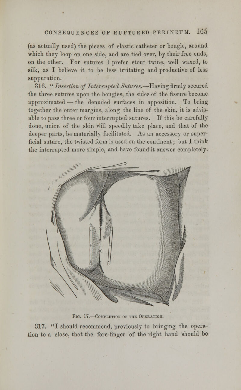 (as actually used) the pieces of elastic catheter or bougie, around which they loop on one side, and are tied over, by their free ends, on the other. For sutures I prefer stout twine, well waxed, to silk, as I believe it to be less irritating and productive of less suppuration. 316.  Insertion of Interrupted Sutures.—Having firmly secured the three sutures upon the bougies, the sides of the fissure become approximated — the denuded surfaces in apposition. To bring together the outer margins, along the line of the skin, it is advis- able to pass three or four interrupted sutures. If this be carefully done, union of the skin will speedily take place, and that of the deeper parts, be materially facilitated. As an accessory or super- ficial suture, the twisted form is used on the continent; but I think the interrupted more simple, and have found it answer completely. ^^ Fig. 17.—Completion of the Operation. 317. I should recommend, previously to bringing the opera- tion to a close, that the fore-finger of the right hand should be