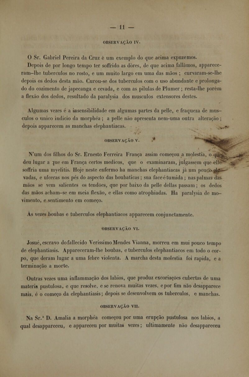 OBSERVAÇÃO IV. O Sr. Gabriel Pereira da Cruz é um exemplo do que acima expuzemos. Depois de por longo tempo ter soffrido as dores, de que acima falíamos, apparece- ram-lhe tubérculos no rosto, e um muito largo em uma das mãos ; curvaram-se-lhe depois os dedos desta mão. Curou-se dos tubérculos com o uso abundante e prolonga- do do cozimento de japecanga e cevada, e com as pílulas de Plumer; resta-lhe porém a flexão dos dedos, resultado da paralysia dos músculos extensores destes. Algumas vezes é a insensibilidade em algumas partes da pelle, e fraqueza de mús- culos o único indicio da morphéa ; a pelle não apresenta nem-uma outra alteração ; depois apparecem as manchas elephantiacas. OBSERVAÇÃO V. ' N'um dos filhos do Sr. Ernesto Ferreira França assim começou a moléstia, o qu deu lugar a que em França certos médicos, que o examinaram, julgassem que «11 soffria uma myelitis. Hoje neste enfermo ha manchas elephantiacas já um pouco vadas, e ulceras nos pés do aspecto das boubaticas ; sua face é túmida ; nas pai mas das mãos se vem salientes os tendões, que por baixo da pelle delias passam; os dedos das mãos acham-se em meia flexão, e ellas como atrophiadas. Ha paralysia de mo- vimento, e sentimento em começo. As vezes boubas e tubérculos elephantiacos apparecem conjunctamente. OBSERVAÇÃO VI. Josué, escravo dofallecido Veríssimo Mendes Vianna, morreu em mui pouco tempo de elephantiasis. Appareceram-lhe boubas, e tubérculos elephantiacos em todo o cor- po, que deram lugar a uma febre violenta. A marcha desta moléstia foi rápida, e a terminação a morte. Outras vezes uma inflammação dos lábios, que produz excoriações cubertas de uma matéria pustulosa, e que resolve, e se renova muitas vezes, epor fim não desapparece mais, é o começo da elephantiasis; depois se desenvolvem os tubérculos, e manchas. OBSERVAÇÃO VII. Na Sr.a D. Amália a morphéa começou por uma erupção pustulosa nos lábios, a qual desappareceu, e appareceu por muitas vezes; ultimamente não desappareceu