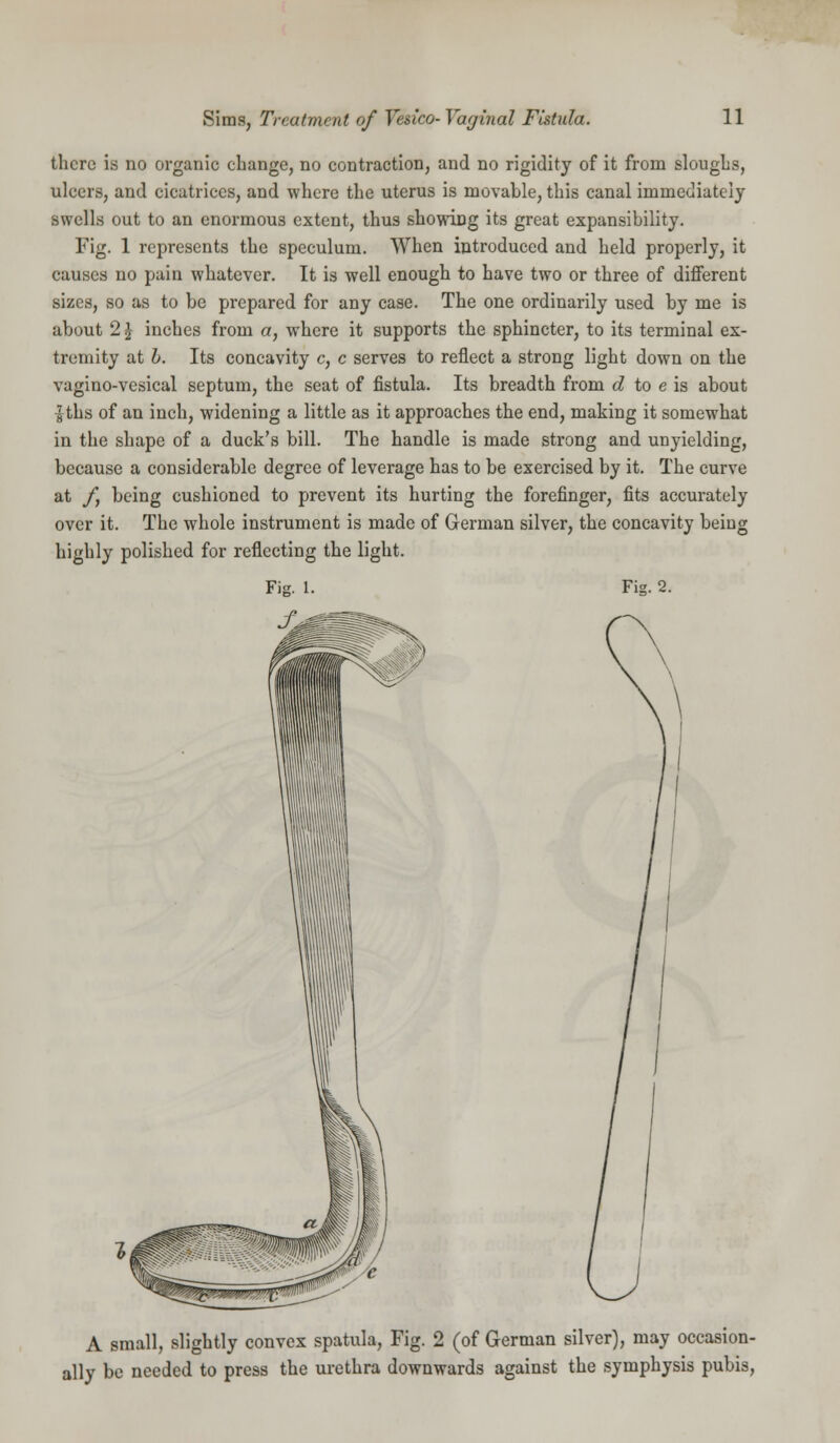 there is no organic change, no contraction, and no rigidity of it from sloughs, ulcers, and cicatrices, and where the uterus is movable, this canal immediately swells out to an enormous extent, thus showing its great expansibility. Fig. 1 represents the speculum. When introduced and held properly, it causes no pain whatever. It is well enough to have two or three of different sizes, so as to be prepared for any case. The one ordinarily used by me is about 2 £ inches from a, where it supports the sphincter, to its terminal ex- tremity at b. Its concavity c, c serves to reflect a strong light down on the vagino-vesical septum, the seat of fistula. Its breadth from d to e is about -gths of an inch, widening a little as it approaches the end, making it somewhat in the shape of a duck's bill. The handle is made strong and unyielding, because a considerable degree of leverage has to be exercised by it. The curve at f} being cushioned to prevent its hurting the forefinger, fits accurately over it. The whole instrument is made of German silver, the concavity being highly polished for reflecting the light. Fig. 1. Fig. 2. A small, slightly convex spatula, Fig. 2 (of German silver), may occasion- ally be needed to press the urethra downwards against the symphysis pubis,