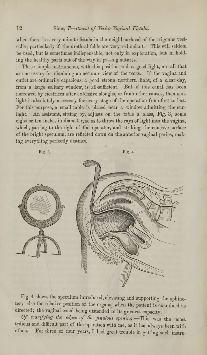 when there is a very minute fistula in the neighbourhood of the trigonus vesi- calis; particularly if the urethral folds are very redundant. This will seldom be used, but is sometimes indispensable, not only in exploration, but in hold- ing the healthy parts out of the way in passing sutures. These simple instruments, with this position and a good light, are all that are necessary for obtaining an accurate view of the parts. If the vagina and outlet are ordinarily capacious, a good strong northern light, of a clear day, from a large solitary window, is all-sufficient. But if this canal has been narrowed by cicatrices after extensive sloughs, or from other causes, then sun- light is absolutely necessary for every stage of the operation from first to last. For this purpose, a small table is placed near a window admitting the sun- light. An assistant, sitting by, adjusts on the table a glass, Fig. 3, some eight or ten inches in diameter, so as to throw the rays of light into the vagina, which, passing to the right of the operator, and striking the concave surface of the bright speculum, are reflected down on the anterior vaginal paries, mak- ing everything perfectly distinct. Fig. 3. Fig. 4. Fig. 4 shows the speculum introduced, elevating and supporting the sphinc- ter; also the relative position of the organs, when the patient is examined as directed; the vaginal canal being distended to its greatest capacity. Of scarifying the edges of the fistulous opening.—This was the most tedious and difficult part of the operation with me, as it has always been with others. For three or four years, I had great trouble in getting such instru-