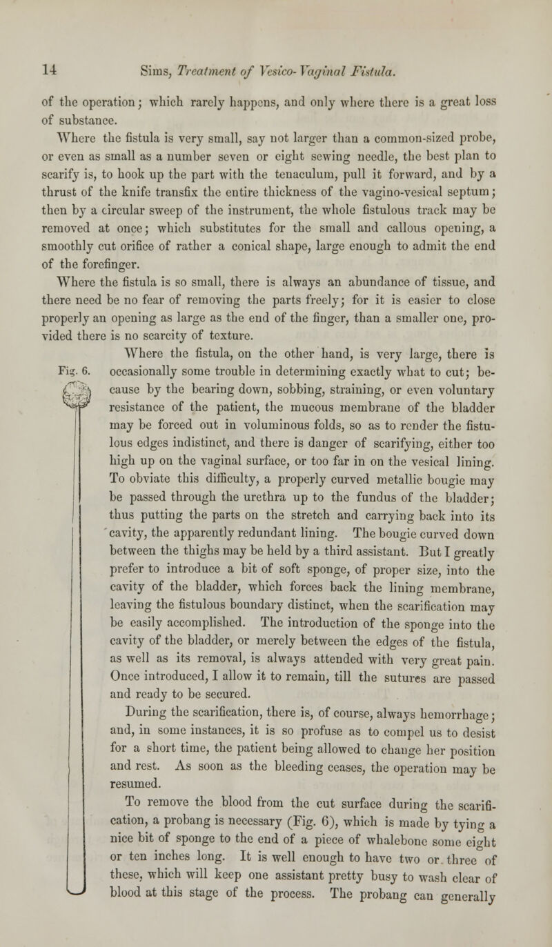 of the operation; which rarely happens, and only where there is a great loss of substance. Where the fistula is very small, say not larger than a common-sized probe, or even as small as a number seven or eight sewing needle, tbe best plan to scarify is, to hook up the part with the tenaculum, pull it forward, and by a thrust of the knife transfix the entire thickness of the vagino-vesical septum; then by a circular sweep of the instrument, the whole fistulous track may be removed at once; which substitutes for the small and callous opening, a smoothly cut orifice of rather a conical shape, large enough to admit the end of the forefinger. Where the fistula is so small, there is always an abundance of tissue, and there need be no fear of removing the parts freely; for it is easier to close properly an opening as large as the end of the finger, than a smaller one, pro- vided there is no scarcity of texture. Where the fistula, on the other hand, is very large, there is Fig. 6. occasionally some trouble in determining exactly what to cut; be- cause by the bearing down, sobbing, straining, or even voluntary resistance of the patient, the mucous membrane of the bladder may be forced out in voluminous folds, so as to render the fistu- lous edges indistinct, and there is danger of scarifying, either too high up on the vaginal surface, or too far in on the vesical lining. To obviate this difficulty, a properly curved metallic bougie may be passed through the urethra up to the fundus of the bladder; thus putting the parts on the stretch and carrying back into its cavity, the apparently redundant lining. The bougie curved down between the thighs may be held by a third assistant. But I greatly prefer to introduce a bit of soft sponge, of proper size, into the cavity of the bladder, which forces back the lining membrane, leaving the fistulous boundary distinct, when the scarification may be easily accomplished. The introduction of the sponge into the cavity of the bladder, or merely between the edges of the fistula, as well as its removal, is always attended with very great pain. Once introduced, I allow it to remain, till the sutures are passed and ready to be secured. During the scarification, there is, of course, always hemorrhage; and, in some instances, it is so profuse as to compel us to desist for a short time, the patient being allowed to change her position and rest. As soon as the bleeding ceases, the operation may be resumed. To remove the blood from the cut surface during the scarifi- cation, a probang is necessary (Fig. 6), which is made by tying a nice bit of sponge to the end of a piece of whalebone some eight or ten inches long. It is well enough to have two or. three of these, which will keep one assistant pretty busy to wash clear of w blood at this stage of the process. The probang can generally