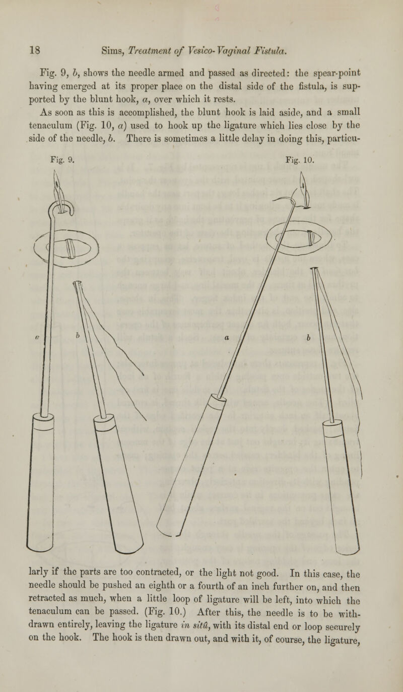 Fig. 9, b, shows the needle armed and passed as directed: the spear-point having emerged at its proper place on the distal side of the fistula, is sup- ported by the blunt hook, a, over which it rests. As soon as this is accomplished, the blunt hook is laid aside, and a small tenaculum (Fig. 10, a) used to hook up the ligature which lies close by the side of the needle, b. There is sometimes a little delay in doing this, particu- Fig. 9. Fig. 10. larly if the parts are too contracted, or the light not good. In this case, the needle should be pushed an eighth or a fourth of an inch further on, and then retracted as much, when a little loop of ligature will be left, into which the tenaculum can be passed. (Fig. 10.) After this, the needle is to be with- drawn entirely, leaving the ligature in sM, with its distal end or loop securely on the hook. The hook is then drawn out, and with it, of course, the ligature,