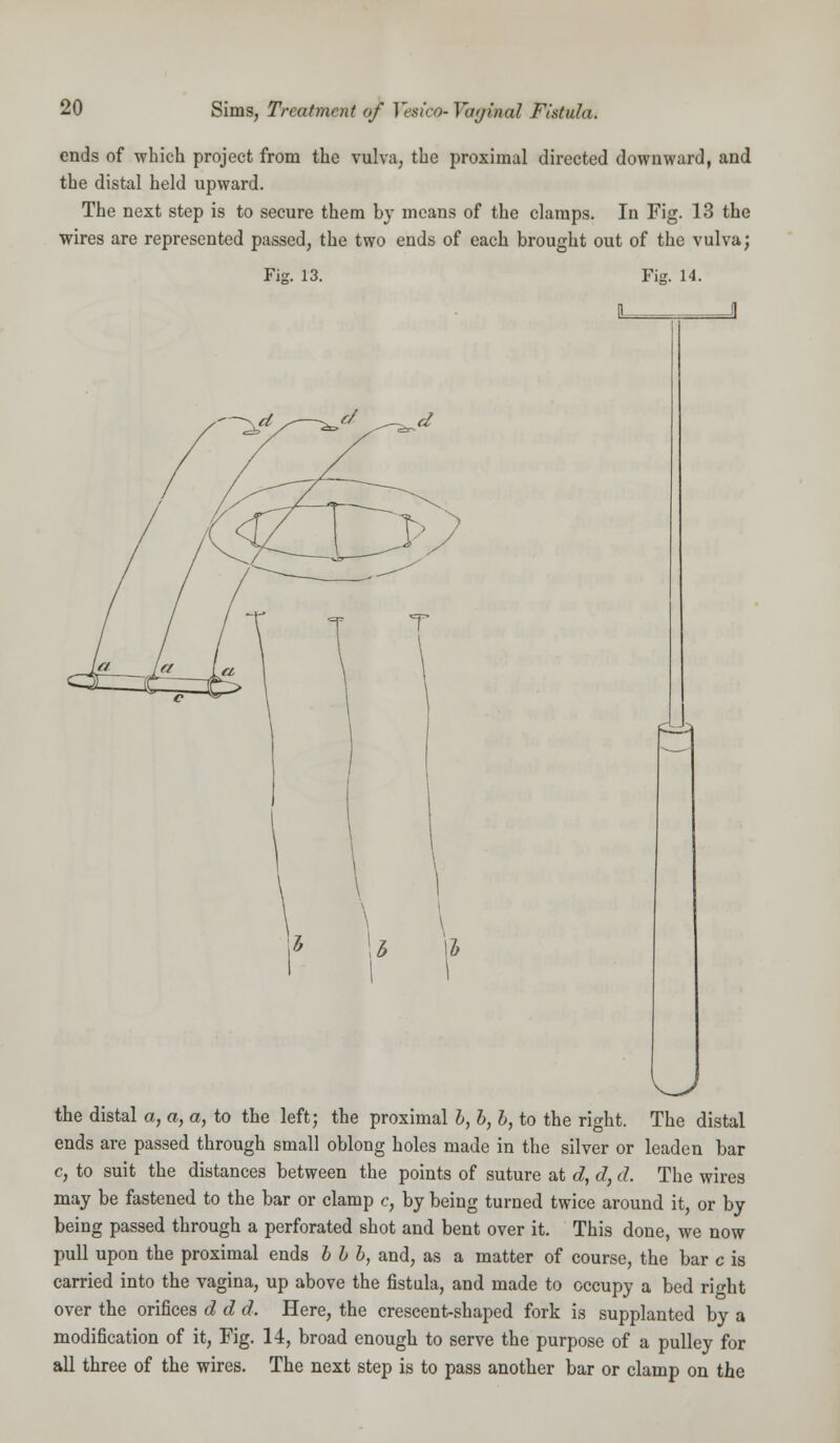 ends of which project from the vulva, the proximal directed downward, and the distal held upward. The next step is to secure them by means of the clamps. In Fig. 13 the wires are represented passed, the two ends of each brought out of the vulva; Fig. 13. Fig. 14. ~-^d/-—^ ^i±-.<t the distal a, a, a, to the left; the proximal b, b, b, to the right. The distal ends are passed through small oblong holes made in the silver or leaden bar c, to suit the distances between the points of suture at d, d, d. The wires may be fastened to the bar or clamp c, by being turned twice around it, or by being passed through a perforated shot and bent over it. This done, we now pull upon the proximal ends bbb, and, as a matter of course, the bar c is carried into the vagina, up above the fistula, and made to occupy a bed right over the orifices d d d. Here, the crescent-shaped fork is supplanted by a modification of it, Fig. 14, broad enough to serve the purpose of a pulley for all three of the wires. The next step is to pass another bar or clamp on the