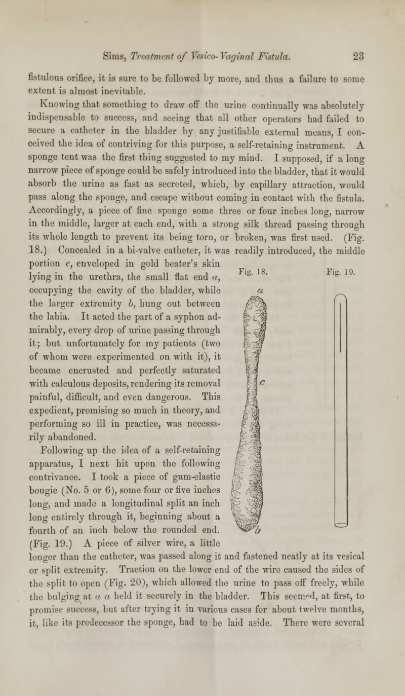 Fig. 19. fistulous orifice, it is sure to be followed by more, and thus a failure to some extent is almost inevitable. Knowing that something to draw off the urine continually was absolutely indispensable to success, and seeing that all other operators had failed to secure a catheter in the bladder by any justifiable external means, I con- ceived the idea of contriving for this purpose, a self-retaining instrument. A sponge tent was the first thing suggested to my mind. I supposed, if a long narrow piece of sponge could be safely introduced into the bladder, that it would absorb the urine as fast as secreted, which, by capillary attraction, would pass along the sponge, and escape without coming in contact with the fistula. Accordingly, a piece of fine sponge some three or four inches long, narrow in the middle, larger at each end, with a strong silk thread passing through its whole length to prevent its being torn, or broken, was first used. (Fig. 18.) Concealed in a bi-valve catheter, it was readily introduced, the middle portion c, enveloped in gold beater's skin lying in the urethra, the small flat end «, occupying the cavity of the bladder, while the larger extremity h, hung out between the labia. It acted the part of a syphon ad- mirably, every drop of urine passing through it; but unfortunately for my patients (two of whom were experimented on with it), it became encrusted and perfectly saturated with calculous deposits, rendering its removal painful, difficult, and even dangerous. This expedient, promising so much in theory, and performing so ill in practice, was necessa- rily abandoned. Following up the idea of a self-retaining apparatus, I next hit upon the following contrivance. I took a piece of gum-elastic bougie (No. 5 or 6), some four or five inches long, and made a longitudinal split an inch long entirely through it, beginning about a fourth of an inch below the rounded end. (Fig. 19.) A piece of silver wire, a little longer than the catheter, was passed along it and fastened neatly at its vesical or split extremity. Traction on the lower end of the wire caused the sides of the split to open (Fig. 20), which allowed the urine to pass off freely, while the bulging at a a held it securely in the bladder. This seemed, at first, to promise success, but after trying it in various cases for about twelve months, it, like its predecessor the sponge, had to be laid aside. There were several