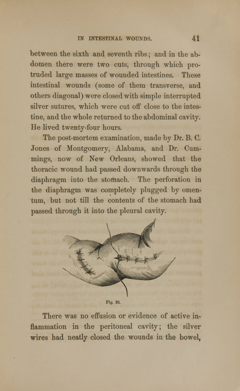 between the sixth and seventh ribs; and in the ab- domen there were two cuts, through which pro- truded large masses of wounded intestines. These intestinal wounds (some of them transverse, and others diagonal) were closed with simple interrupted silver sutures, which were cut off close to the intes- tine, and the whole returned to the abdominal cavity. He lived twenty-four hours. The post-mortem examination, made by Dr. B. C. Jones of Montgomery, Alabama-, and Dr. Cum- mings, now of New Orleans, showed that the thoracic wound had passed downwards through the diaphragm into the stomach. The perforation in the diaphragm was completely plugged by omen- tum, but not till the contents of the stomach had passed through it into the pleural cavity. Fig. 20. There was no effusion or evidence of active in- flammation in the peritoneal cavity; the silver wires had neatly closed the wounds in the bowel,