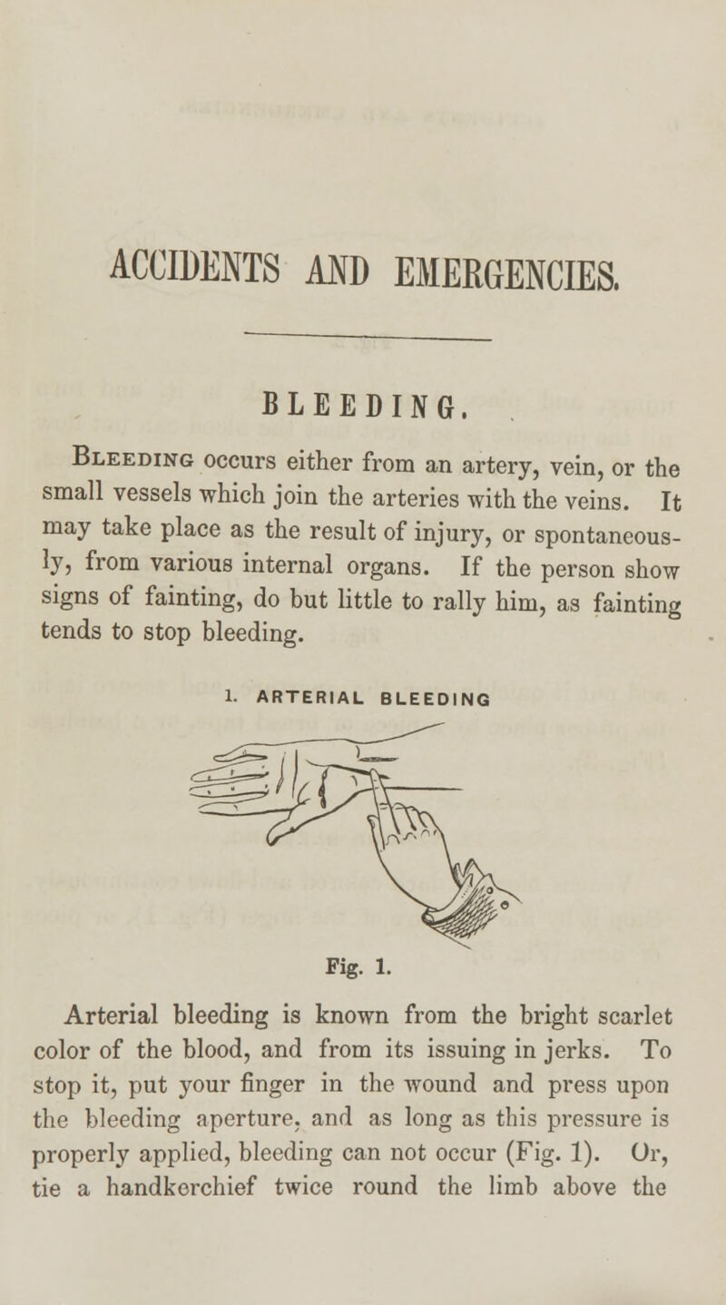 ACCIDENTS AND EMERGENCIES, BLEEDING, Bleeding occurs either from an artery, vein, or the small vessels which join the arteries with the veins. It may take place as the result of injury, or spontaneous- ly, from various internal organs. If the person show signs of fainting, do but little to rally him, as fainting tends to stop bleeding. 1. ARTERIAL BLEEDING Fig. 1. Arterial bleeding is known from the bright scarlet color of the blood, and from its issuing in jerks. To stop it, put your finger in the wound and press upon the bleeding aperture, and as long as this pressure is properly applied, bleeding can not occur (Fig. 1). Or, tie a handkerchief twice round the limb above the