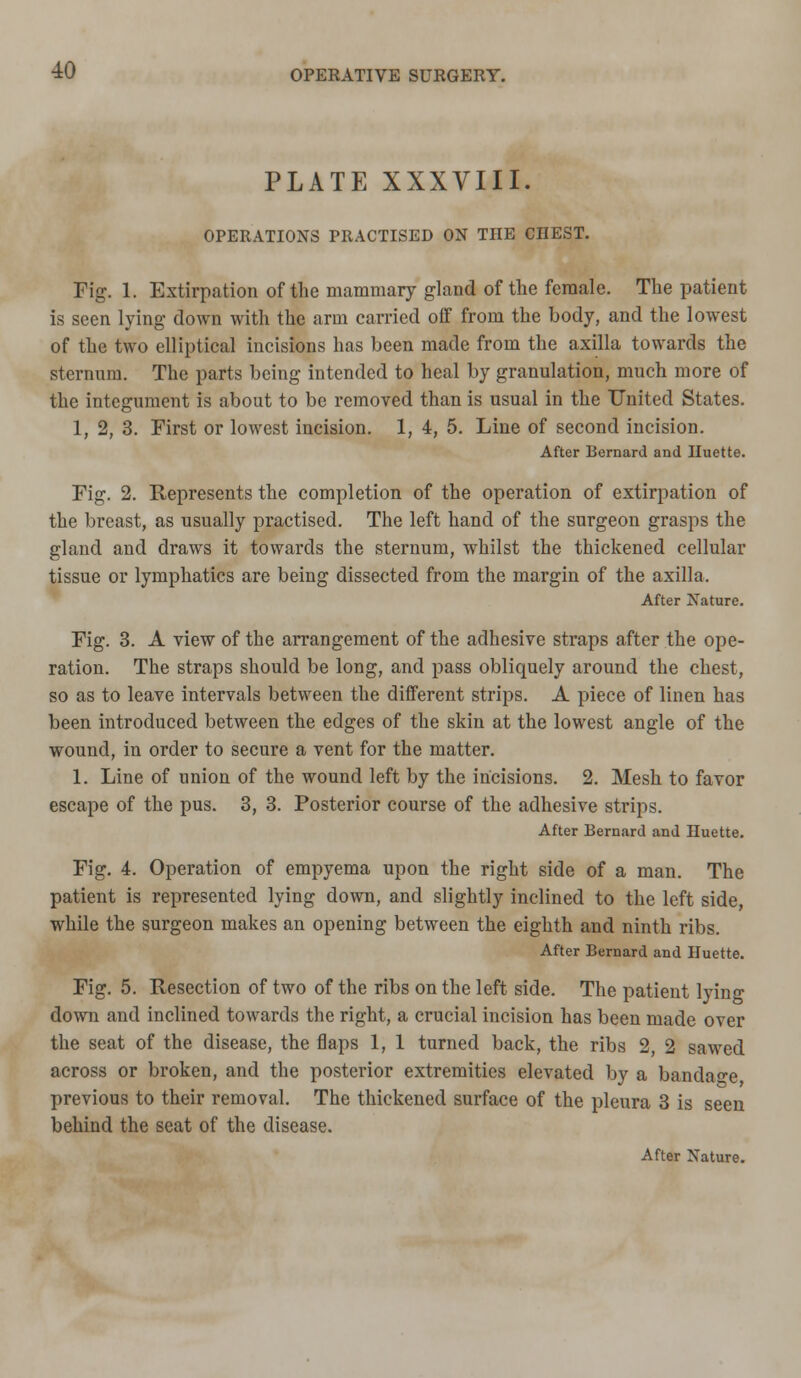 PLATE XXXVIII. OPERATIONS PRACTISED ON THE CHEST. Fig. 1. Extirpation of the mammary gland of the female. The patient is seen lying clown with the arm carried off from the body, and the lowest of the two elliptical incisions has been made from the axilla towards the sternum. The parts being intended to heal by granulation, much more of the integument is about to be removed than is usual in the United States. 1, 2, 3. First or lowest incision. 1, 4, 5. Line of second incision. After Bernard and Huette. Fig. 2. Represents the completion of the operation of extirpation of the breast, as usually practised. The left hand of the surgeon grasps the gland and draws it towards the sternum, whilst the thickened cellular tissue or lymphatics are being dissected from the margin of the axilla. After Nature. Fig. 3. A view of the arrangement of the adhesive straps after the ope- ration. The straps should be long, and pass obliquely around the chest, so as to leave intervals between the different strips. A piece of linen has been introduced between the edges of the skin at the lowest angle of the wound, in order to secure a vent for the matter. 1. Line of union of the wound left by the incisions. 2. Mesh to favor escape of the pus. 3, 3. Posterior course of the adhesive strips. After Bernard and Huette. Fig. 4. Operation of empyema upon the right side of a man. The patient is represented lying down, and slightly inclined to the left side, while the surgeon makes an opening between the eighth and ninth ribs. After Bernard and Huette. Fig. 5. Resection of two of the ribs on the left side. The patient lying down and inclined towards the right, a crucial incision has been made over the seat of the disease, the flaps 1, 1 turned back, the ribs 2, 2 sawed across or broken, and the posterior extremities elevated by a bandace previous to their removal. The thickened surface of the pleura 3 is seen behind the seat of the disease. After Nature.