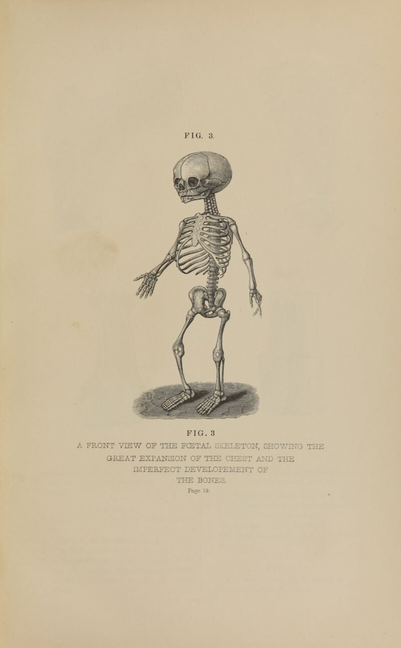 FIG. 3 A FRONT VIEW OF THE FCETAL SKELETON, SHOWING- THE GREAT EXPANSION OF THE CHEST AND THE IMPERFECT DEVFJLOPEMENT OF THE BONES. Pas?e 19.