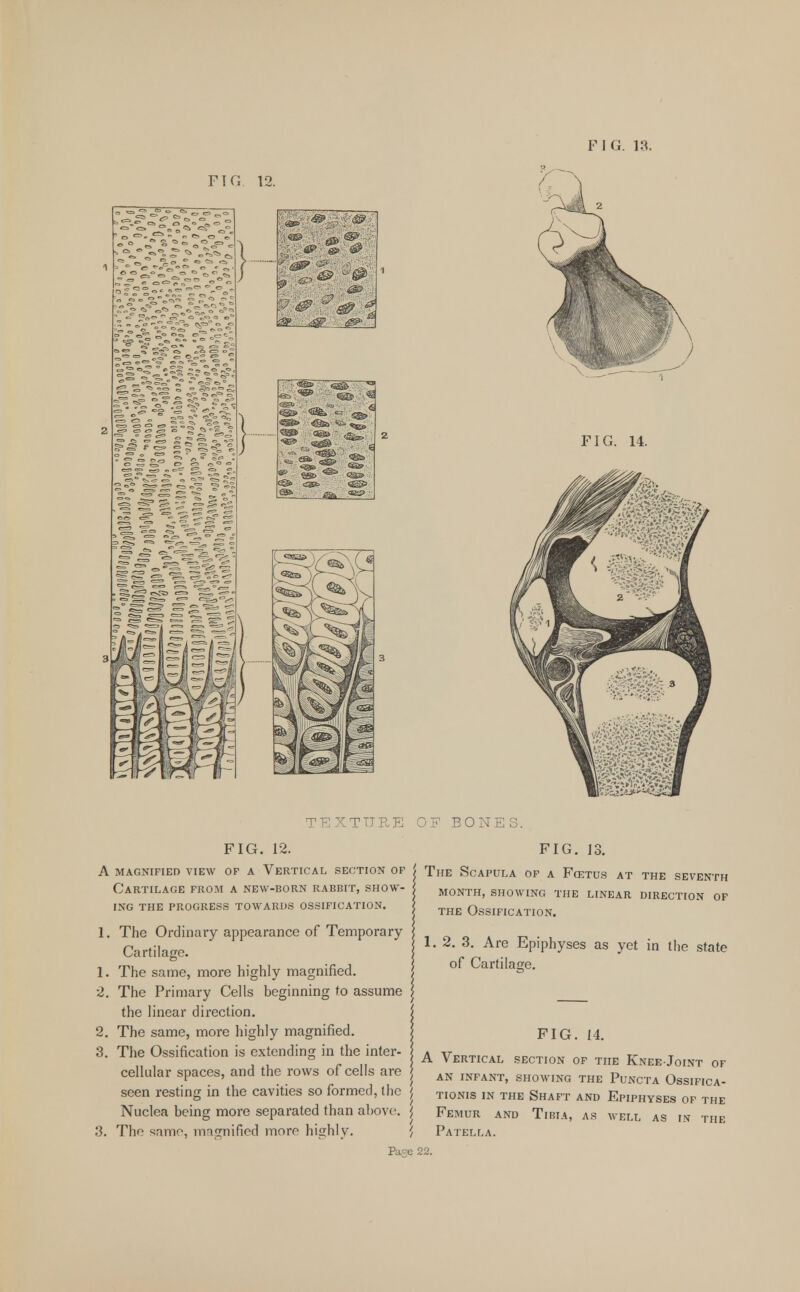 no 12. FIG. 14. TUP.K OF BONES. FIG. 12. A MAGNIFIED VIEW OF A VERTICAL SECTION OF GARTILAGE FROM A NEW-BORN RABBIT, SHOW- ING THE PROGRESS TOWARDS OSSIFICATION. 1. The Ordinary appearance of Temporary Cartilage. 1. The same, more highly magnified. 2. The Primary Cells beginning to assume the linear direction. 2. The same, more highly magnified. 3. The Ossification is extending in the inter- cellular spaces, and the rows of cells are seen resting in the cavities so formed, the Nuclea being more separated than above. 3. The same, mngnificd more highly. FIG. 13. j The Scapula of a Fcetus at the seventh MONTH, SHOWING THE LINEAR DIRECTION OF the Ossification. 1. 2. 3. Are Epiphyses as yet in the state of Cartilage. FIG. 14. A Vertical section of the KneeJoint of an infant, showing the Puncta Ossifica- | tionis in the shaft and epiphyses of the | Femur and Tibia, as well as in the ', Patella. •e 22.