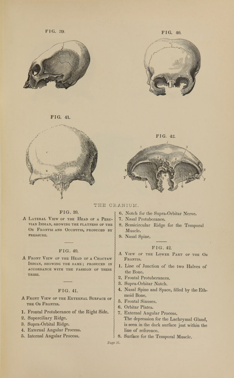 FIG. 41. FIG. 42. THE CRANIUM. FIG. 39. A Lateral View of the Head of a Peru- vian Indian, showing the flatness of the Os Frontis and Occipitis, produced by pressure. 6. Notch for the Supra-Orbitar Nerve. 7. Nasal Protuberance. 8. Semicircular Ridge for the Temporal Muscle. 9. Nasal Spine. FIG. 40. A Front View of the Head of a Choctaw Indian, showing the same ; produced in accordance with the fashion of their TRIBE. FIG. 41. A Front View of the External Surface of the Os Frontis. 1. Frontal Protuberance of the Right Side. 2. Superciliary Ridge. 3. Supra-Orbital Ridge. 4. External Angular Process. 5. Internal Angular Process. FIG. 42. A View of the Lower Part of the Os Frontis. 1. Line of Junction of the two Halves of the Bone. 2. Frontal Protuberances. 3. Supra-Orbitar Notch. 4. Nasal Spine and Space, filled by the Eth- moid Bone. 5. Frontal Sinuses. 6. Orbitar Plates. 7. External Angular Process. The depression for the Lachrymal Gland, is seen in the dark surface just within the line of reference. 8. Surface for the Temporal Muscle.