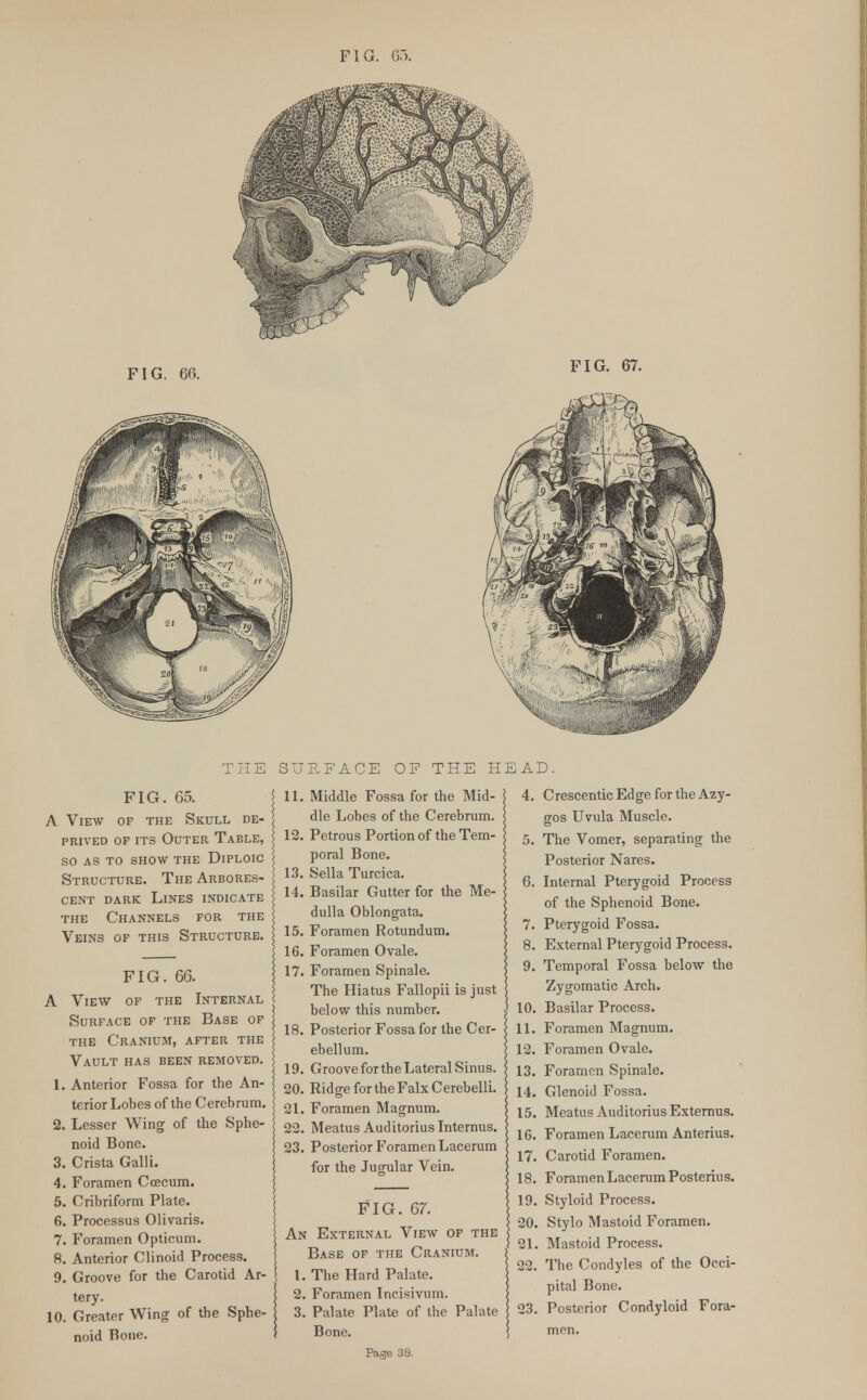 FIG. 65. A View of the Skull de- prived of its Outer Table, so as to show the diploic Structure. The Arbores- cent dark Lines indicate the Channels for the Veins of this Structure. FIG. 66. A View of the Internal Surface of the Base of the Cranium, after the Vault has been removed. 1. Anterior Fossa for the An- terior Lobes of the Cerebrum. 2. Lesser Wing of the Sphe- noid Bone. 3. Crista Galli. 4. Foramen Ccecum. 5. Cribriform Plate. 6. Processus divans. 7. Foramen Opticum. 8. Anterior Clinoid Process. 9. Groove for the Carotid Ar- tery. 10. Greater Wing of the Sphe- noid Bone. THE SURFACE OF THE HEA 4. 5 11. Middle Fossa for the Mid- dle Lobes of the Cerebrum. 12. Petrous Portion of the Tem- poral Bone. 13. Sella Turcica. 14. Basilar Gutter for the Me- dulla Oblongata. 15. Foramen Rotundum. 16. Foramen Ovale. 17. Foramen Spinale. The Hiatus Fallopii is just below this number. 18. Posterior Fossa for the Cer- ebellum. 19. Groove for the Lateral Sinus. 20. Ridge for the FalxCerebelli. 21. Foramen Magnum. 22. Meatus Auditoriuslnternus. 23. Posterior Foramen Lacerum for the Jugular Vein. FIG. 67. An External View of the Base of the Cranium. 1. The Hard Palate. 2. Foramen Incisivum. 3. Palate Plate of the Palate Bone. Page 38. D. Crescentic Edge for the Azy- gos Uvula Muscle. 5. The Vomer, separating the Posterior Nares. 6. Internal Pterygoid Process of the Sphenoid Bone. 7. Pterygoid Fossa. 8. External Pterygoid Process. 9. Temporal Fossa below the Zygomatic Arch. 10. Basilar Process. 11. Foramen Magnum. 12. Foramen Ovale. 13. Foramen Spinale. 14. Glenoid Fossa. 15. Meatus Auditorius Externus. 16. Foramen Lacerum Anterius. 17. Carotid Foramen. 18. Foramen Lacerum Posterius. 19. Styloid Process. 20. Stylo Mastoid Foramen. 21. Mastoid Process. 22. The Condyles of the Occi- pital Bone. 23. Posterior Condyloid Fora- men.