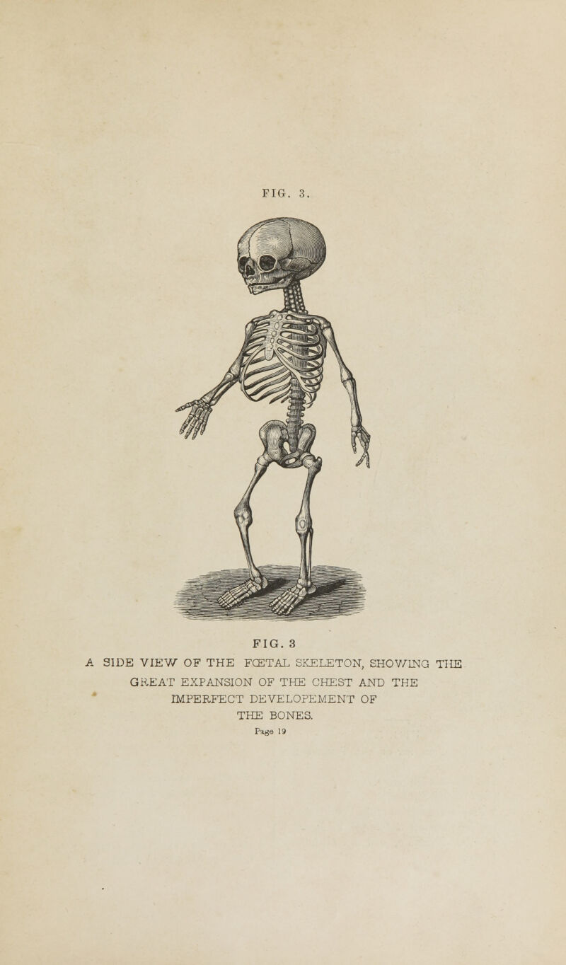 FIG. 3 A SIDE VIEW OF THE FCETAL SKELETON, SHOWING THE GREAT EXPANSION OF THE CHEST AND THE IMPERFECT DEVELOPEMENT OF THE BONES.