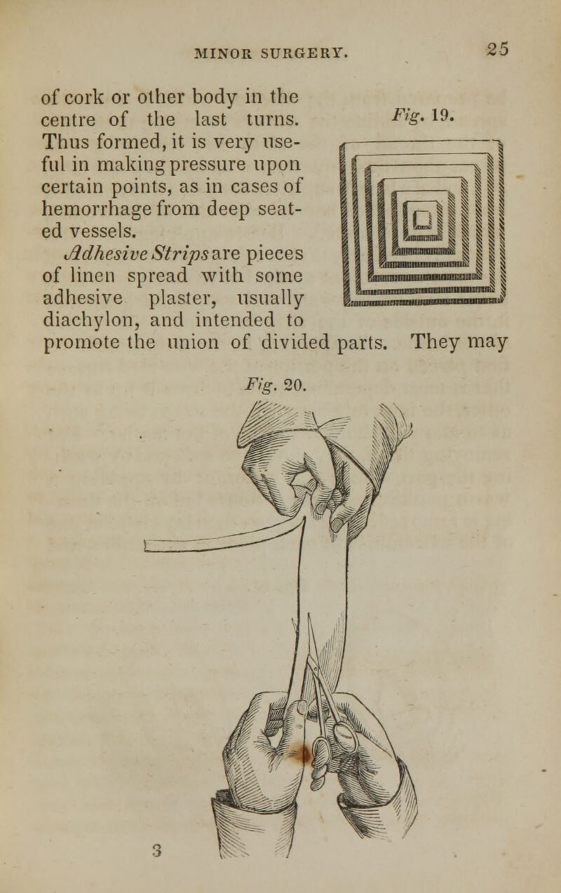 Fig. 19. of cork or other body in the centre of the last turns. Thus formed, it is very use- ful in making pressure upon certain points, as in cases of hemorrhage from deep seat- ed vessels. Adhesive Strips are pieces of linen spread with some adhesive plaster, usually diachylon, and intended to promote the union of divided parts. They may