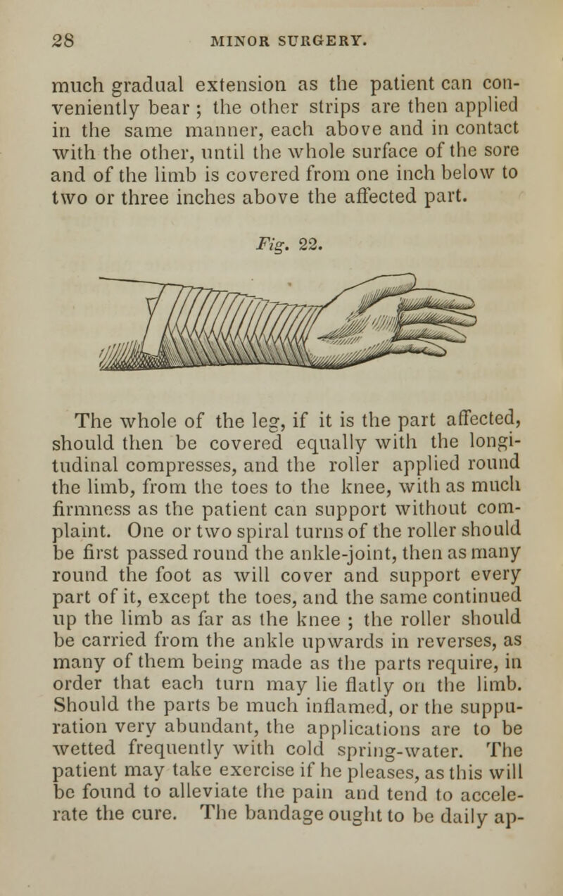 much gradual extension as the patient can con- veniently bear ; the other strips are then applied in the same manner, each above and in contact with the other, until the whole surface of the sore and of the limb is covered from one inch below to two or three inches above the affected part. Fig. 22. The whole of the leg, if it is the part affected, should then be covered equally with the longi- tudinal compresses, and the roller applied round the limb, from the toes to the knee, with as much firmness as the patient can support without com- plaint. One or two spiral turns of the roller should be first passed round the ankle-joint, then as many round the foot as will cover and support every part of it, except the toes, and the same continued up the limb as far as the knee ; the roller should be carried from the ankle upwards in reverses, as many of them being made as the parts require, in order that each turn may lie flatly on the limb. Should the parts be much inflamed, or the suppu- ration very abundant, the applications are to be wetted frequently with cold spring-water. The patient may take exercise if he pleases, as this will be found to alleviate the pain and tend to accele- rate the cure. The bandage ought to be daily ap-