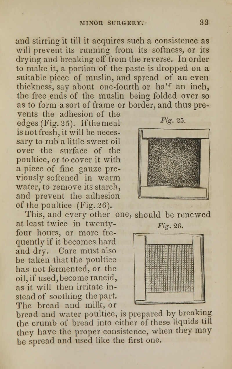 Fig. 25. and stirring it till it acquires such a consistence as will prevent its running from its softness, or its drying and breaking off from the reverse. In order to make it, a portion of the paste is dropped on a suitable piece of muslin, and spread of an even thickness, say about one-fourth or ha,f an inch, the free ends of the muslin being folded over so as to form a sort of frame or border, and thus pre- vents the adhesion of the edges (Fig. 25). If the meal is not fresh, it will be neces- sary to rub a little sweet oil over the surface of the poultice, or to cover it with a piece of fine gauze pre- viously softened in warm water, to remove its starch, and prevent the adhesion of the poultice (Fig. 26). This, and every other one, should be renewed at least twice in twenty- Fic.26. four hours, or more fre- quently if it becomes hard and dry. Care must also be taken that the poultice has not fermented, or the oil, if used,become rancid, as it will then irritate in- stead of soothing the part. The bread and milk, or bread and water poultice, is prepared by breaking the crumb of bread into either of these liquids till they have the proper consistence, when they may be spread and used like the first one.