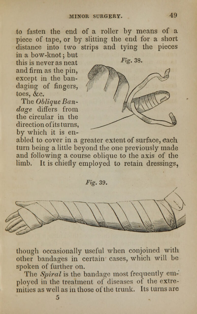 to fasten the end of a roller by means of a piece of tape, or by slitting the end for a short distance into two strips and tying the pieces in a bow-knot; but this is never as neat and firm as the pin, except in the ban- daging of fingers, toes, &c. The Oblique Ban- dage differs from the circular in the direction of its turns, by which it is en- abled to cover in a greater extent of surface, each turn being a little beyond the one previously made and following a course oblique to the axis of the limb. It is chiefly employed to retain dressings, Fig. 39. though occasionally useful when conjoined with other bandages in certain cases, which will be spoken of further on. The Spiral is the bandage most frequently em- ployed in the treatment of diseases of the extre- mities as well as in those of the trunk. Its turns are 5