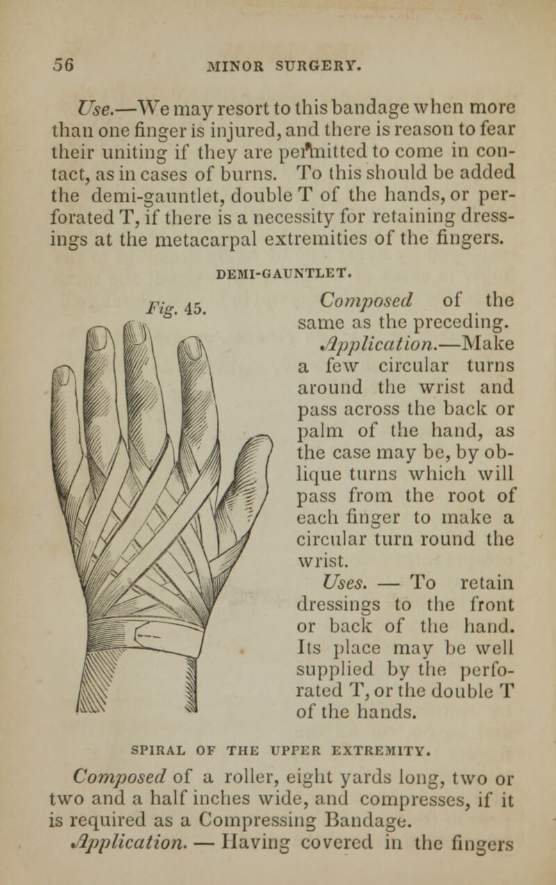 Use.—We may resort to this bandage when more than one finger is injured, and there is reason to fear their uniting if they are peilriittcd to come in con- tact, as in cases of burns. To this should be added the demi-ganntlet, double T of the hands, or per- forated T, if there is a necessity for retaining dress- ings at the metacarpal extremities of the fingers. DEMI-GAUNTLET. Fig. 45. Composed of the same as the preceding. Application.—Make a few circular turns around the wrist and pass across the back or palm of the hand, as the case may be, by ob- lique turns which will pass from the root of each finger to make a circular turn round the wrist. Uses. — To retain dressings to the front or back of the hand. Its place may be well supplied by the perfo- rated T, or the double T of the hands. SPIRAL OF THE UPPER EXTREMITY. Composed of a roller, eight yards long, two or two and a half inches wide, and compresses, if it is required as a Compressing Bandage. Application. — Having covered in the fingers