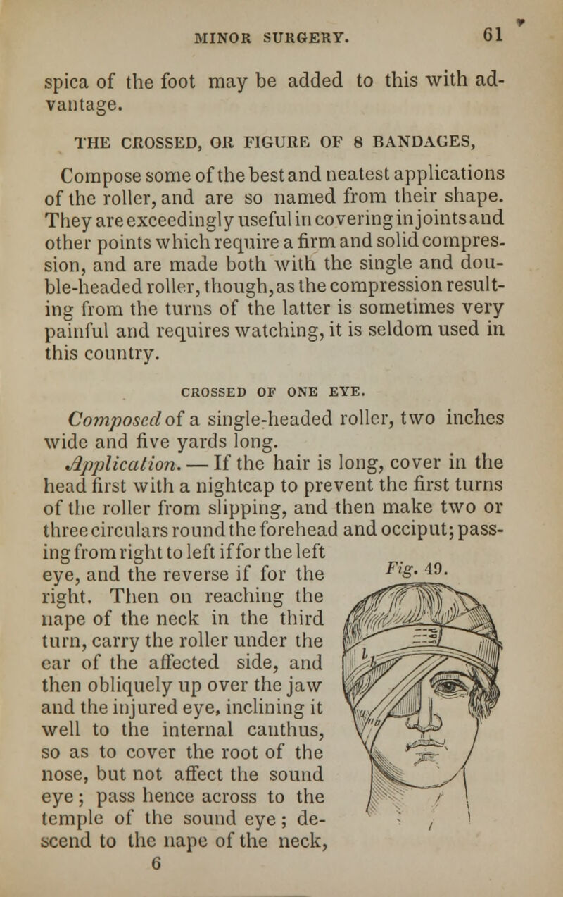 spica of the foot may be added to this with ad- vantage. THE CROSSED, OR FIGURE OF 8 BANDAGES, Compose some of the best and neatest applications of the roller, and are so named from their shape. They are exceedingly useful in covering in joints and other points which require a firm and solid compres- sion, and are made both with the single and dou- ble-headed roller, though,as the compression result- ing from the turns of the latter is sometimes very painful and requires watching, it is seldom used in this country. CROSSED OF ONE EYE. Composed of a single-headed roller, two inches wide and five yards long. Application. — If the hair is long, cover in the head first with a nightcap to prevent the first turns of the roller from slipping, and then make two or three circulars round the forehead and occiput; pass- ing from right to left if for the left eye, and the reverse if for the right. Then on reaching the nape of the neck in the third turn, carry the roller under the car of the affected side, and then obliquely up over the jaw and the injured eye, inclining it well to the internal canthus, so as to cover the root of the nose, but not affect the sound eye ; pass hence across to the temple of the sound eye; de- scend to the nape of the neck, 6 Fig. 49.