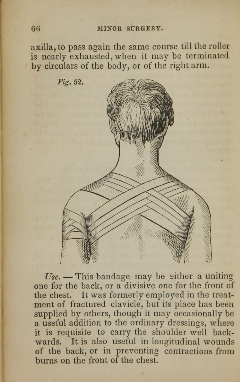 axilla, to pass again the same course till the roller is nearly exhausted, when it maybe terminated by circulars of the body, or of the right arm. Fig. 52. Use. — This bandage may be either a uniting one for the back, or a divisive one for the front of the chest. It was formerly employed in the treat- ment of fractured clavicle, but its place has been supplied by others, though it may occasionally be a useful addition to the ordinary dressings, where it is requisite to carry the shoulder well back- wards. It is also useful in longitudinal wounds of the back, or in preventing contractions from burns on the front of the chest.