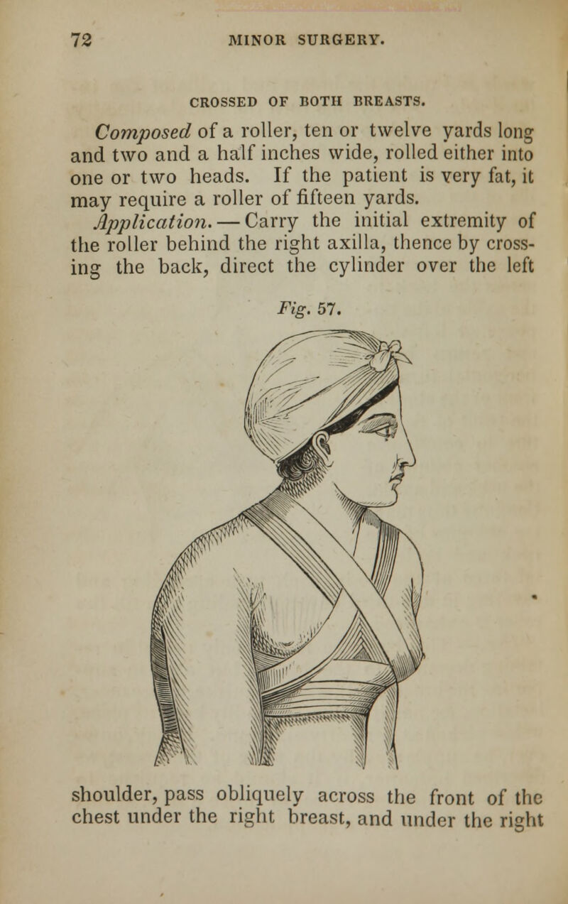 CROSSED OF BOTH BREASTS. Composed of a roller, ten or twelve yards long and two and a half inches wide, rolled either into one or two heads. If the patient is very fat, it may require a roller of fifteen yards. Application. — Carry the initial extremity of the roller behind the right axilla, thence by cross- ing the back, direct the cylinder over the left Fig. 57. shoulder, pass obliquely across the front of the chest under the right breast, and under the right