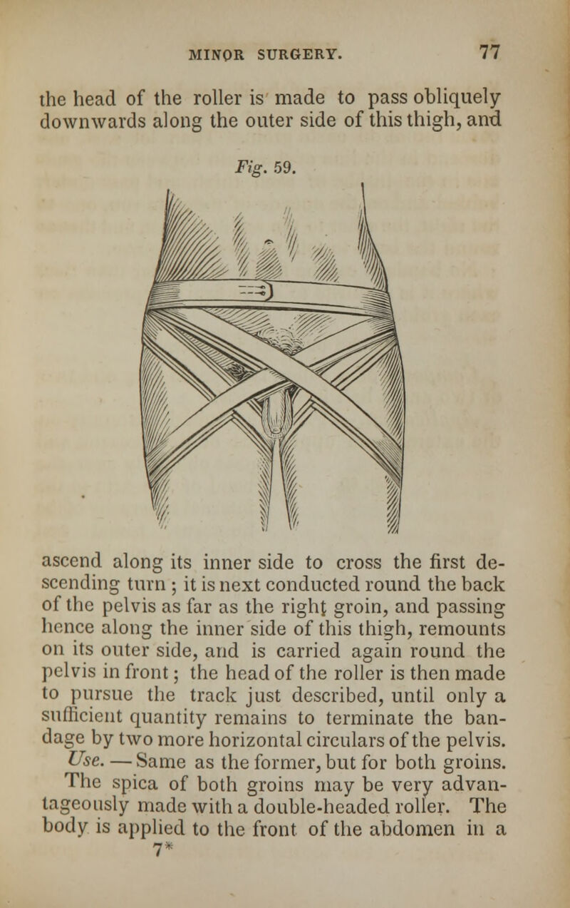 the head of the roller is made to pass obliquely downwards along the outer side of this thigh, and Fig. 59. ascend along its inner side to cross the first de- scending turn ; it is next conducted round the back of the pelvis as far as the right groin, and passing hence along the inner side of this thigh, remounts on its outer side, and is carried again round the pelvis in front; the head of the roller is then made to pursue the track just described, until only a sufficient quantity remains to terminate the ban- dage by two more horizontal circulars of the pelvis. Use. — Same as the former, but for both groins. The spica of both groins may be very advan- tageously made with a double-headed roller. The body is applied to the front of the abdomen in a 7*