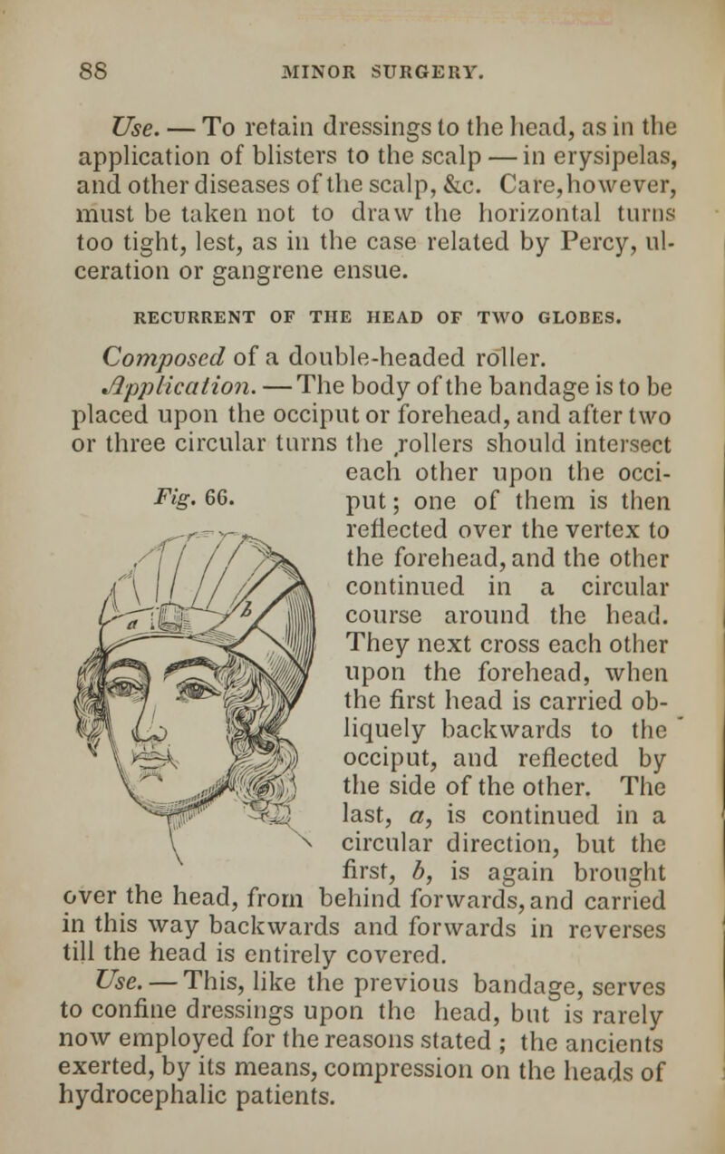 Fig. 66. Use. — To retain dressings to the head, as in the application of blisters to the scalp — in erysipelas, and other diseases of the scalp, &c. Care,however, must be taken not to draw the horizontal turns too tight, lest, as in the case related by Percy, ul- ceration or gangrene ensue. RECURRENT OF THE HEAD OF TWO GLOBES. Composed of a double-headed roller. Application. — The body of the bandage is to be placed upon the occiput or forehead, and after two or three circular turns the .rollers should intersect each other upon the occi- put; one of them is then reflected over the vertex to the forehead, and the other continued in a circular course around the head. They next cross each other upon the forehead, when the first head is carried ob- liquely backwards to the ' occiput, and reflected by the side of the other. The last, a, is continued in a circular direction, but the first, b, is again brought over the head, from behind forwards, and carried in this way backwards and forwards in reverses till the head is entirely covered. Use. — This, like the previous bandage, serves to confine dressings upon the head, but is rarely now employed for the reasons stated ; the ancients exerted, by its means, compression on the heads of hydrocephalic patients.