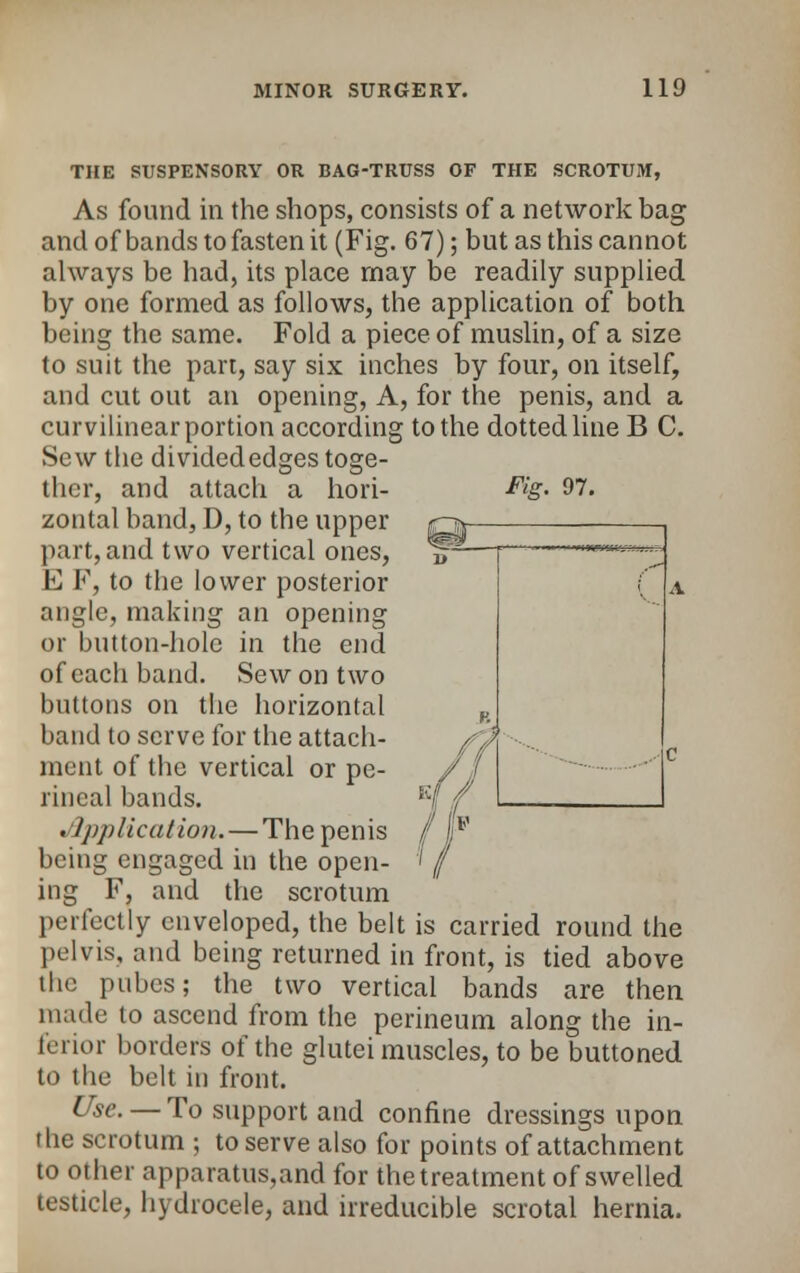 Fig. 97. THE SUSPENSORY OR BAG-TRUSS OF THE SCROTUM, As found in the shops, consists of a network bag and of bands to fasten it (Fig. 67); but as this cannot always be had, its place may be readily supplied by one formed as follows, the application of both being the same. Fold a piece of muslin, of a size to suit the part, say six inches by four, on itself, and cut out an opening, A, for the penis, and a curvilinear portion according to the dotted line B C. Sew the divided edges toge- ther, and attach a hori- zontal band, D, to the upper part, and two vertical ones, E F, to the lower posterior angle, making an opening or button-hole in the end of each band. Sew on two buttons on the horizontal band to serve for the attach- ment of the vertical or pe- rineal bands. Application. — The penis being engaged in the open- ing F, and the scrotum perfectly enveloped, the belt is carried round the pelvis, and being returned in front, is tied above the pubes; the two vertical bands are then made to ascend from the perineum along the in- ferior borders of the glutei muscles, to be buttoned to the belt in front. Use.— To support and confine dressings upon the scrotum ; to serve also for points of attachment to other apparatus,and for the treatment of swelled testicle, hydrocele, and irreducible scrotal hernia.