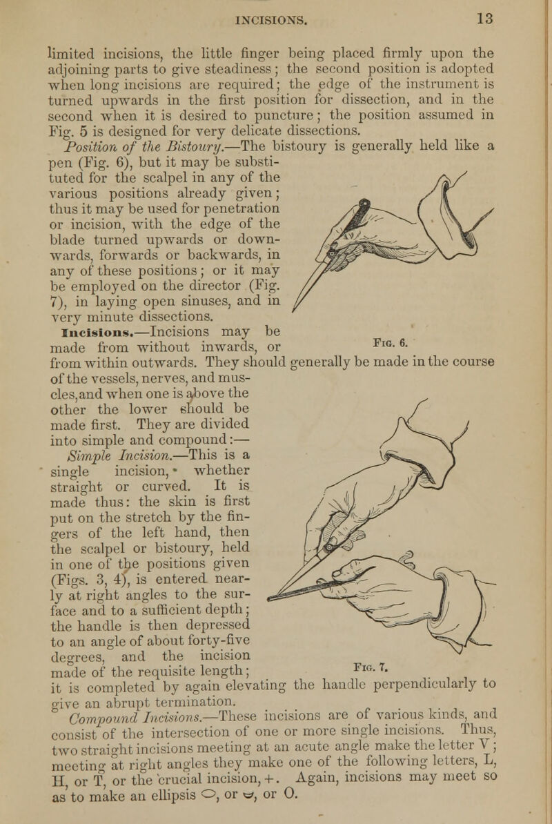 Fig. 6. limited incisions, the little finger being placed firmly upon the adjoining parts to give steadiness ; the second position is adopted when long incisions are required; the edge of the instrument is turned upwards in the first position for dissection, and in the second when it is desired to puncture; the position assumed in Fig. 5 is designed for very delicate dissections. Position of the Bistoury.—The bistoury is generally held like a pen (Fig. 6), but it may be substi- tuted for the scalpel in any of the various positions already given; thus it may be used for penetration or incision, with the edge of the blade turned upwards or down- wards, forwards or backwards, in any of these positions ; or it may be employed on the director (Fig. 7), in laying open sinuses, and in very minute dissections. incisions.—Incisions may be made from without inwards, or from within outwards. They should generally be made in the course of the vessels, nerves, and mus- cles, and when one is above the other the lower should be made first. They are divided into simple and compound:— Simple Incision.—This is a single incision, • whether straight or curved. It is made thus: the skin is first put on the stretch by the fin- gers of the left hand, then the scalpel or bistoury, held in one of the positions given (Figs. 3, 4), is entered near- ly at right angles to the sur- face and to a sufficient depth; the handle is then depressed to an angle of about forty-five degrees, and the incision made of the requisite length; it is completed by again elevating the handle perpendicularly to give an abrupt termination. Compound Incisions.—These incisions are of various kinds, and consist of the intersection of one or more single incisions. Thus, two straight incisions meeting at an acute angle make the letter V; meeting at right angles they make one of the following letters, L, H or T, or the crucial incision, +. Again, incisions may meet so as to make an ellipsis O, or *=/, or 0.
