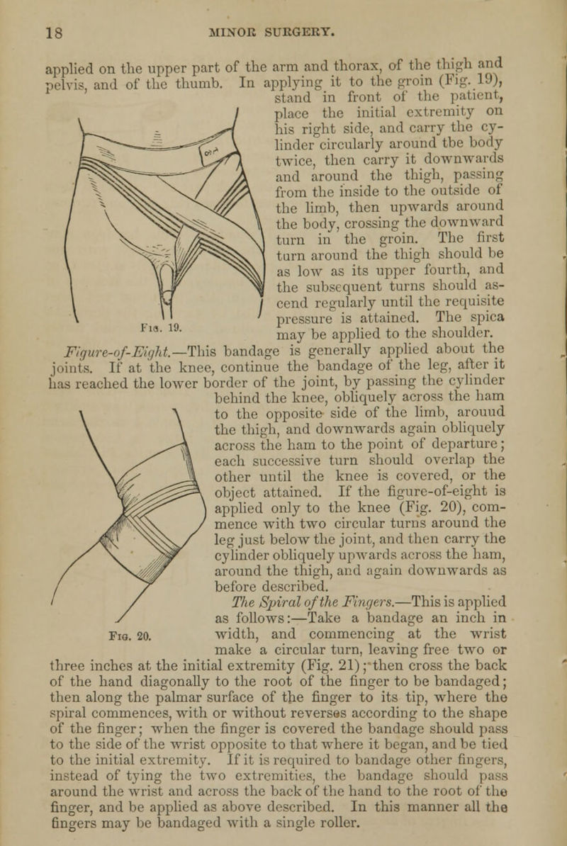 applied on the upper part of the arm and thorax, of the thigh and pelvis, and of the thumb. In applying it to the groin (Fig. 1J), stand in front of the patient, place the initial extremity on his right side, and carry the cy- linder circularly around tbe body twice, then carry it downwards and around the thigh, passing from the inside to the outside of the limb, then upwards around the body, crossing the downward turn in the groin. The first turn around the thigh should be as low as its upper fourth, and the subsequent turns should as- cend regularly until the requisite pressure is attained. The spica may be applied to the shoulder. Figure~of-Mght— This bandage is generally applied about the joints. If at the knee, continue the bandage of the leg, after it has reached the lower border of the joint, by passing the cylinder behind the knee, obliquely across the ham to the opposite side of the limb, arouud the thigh, and downwards again obliquely across the ham to the point of departure; each successive turn should overlap the other until the knee is covered, or the object attained. If the figure-of-eight is applied only to the knee (Fig. 20), com- mence with two circular turns around the leg just below the joint, and then carry the cylinder obliquely upwards across the ham, around the thigh, and again downwards as before described. The Spiral of the Mngers.—This is applied as follows:—Take a bandage an inch in make a circular turn, leaving free two or three inches at the initial extremity (Fig. 21) ;*then cross the back of the hand diagonally to the root of the finger to be bandaged; then along the palmar surface of the finger to its tip, where the spiral commences, with or without reverses according to the shape of the finger; when the finger is covered the bandage should pass to the side of the wrist opposite to that where it began, and be tied to the initial extremity. If it is required to bandage other fingers, instead of tying the two extremities, the bandage should pass around the wrist and across the back of the hand to the root of the finger, and be applied as above described. In this manner all the fingers may be bandaged with a single roller.