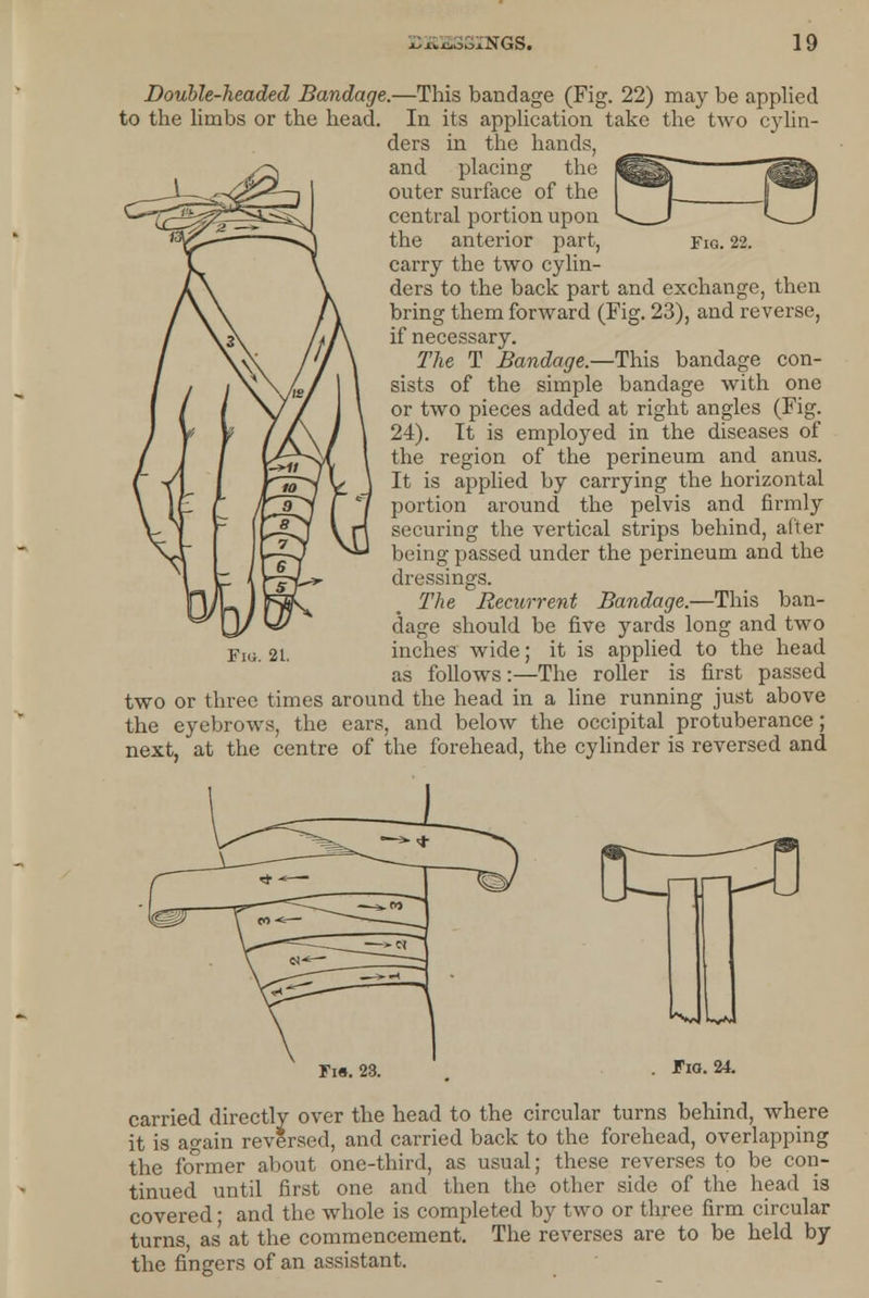 Fig. 22. Double-headed Bandage.—This bandage (Fig. 22) may be applied to the limbs or the head. In its application take the two cylin- ders in the hands, and placing the outer surface of the central portion upon the anterior part, carry the two cylin- ders to the back part and exchange, then bring them forward (Fig. 23), and reverse, if necessary. The T Bandage.—This bandage con- sists of the simple bandage with one or two pieces added at right angles (Fig. 24). It is employed in the diseases of the region of the perineum and anus. It is applied by carrying the horizontal portion around the pelvis and firmly securing the vertical strips behind, after being passed under the perineum and the dressings. The Recurrent Bandage.—This ban- dage should be five yards long and two inches wide; it is applied to the head as follows:—The roller is first passed two or three times around the head in a line running just above the eyebrows, the ears, and below the occipital protuberance; next, at the centre of the forehead, the cylinder is reversed and Fig. 21. Fi«. 23. Fig. 24 carried directly over the head to the circular turns behind, where it is again reversed, and carried back to the forehead, overlapping the Ibrmer about one-third, as usual; these reverses to be con- tinued until first one and then the other side of the head is covered ■ and the whole is completed by two or three firm circular turns, as at the commencement. The reverses are to be held by the fingers of an assistant.