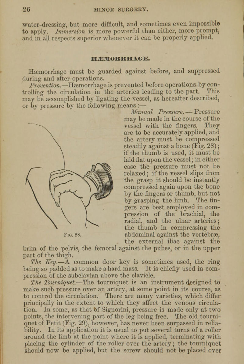 water-dressing, but more difficult, and sometimes even impossible to apply. Immersion is more powerful than either, more prompt, and in all respects superior whenever it can be properly applied. ii^ivoiiuu v«;s;. Haemorrhage must be guarded against before, and suppressed during and after operations. Prevention.—Hemorrhage is prevented before operations by con- trolling the circulation in the arteries leading to the part. This may be accomplished by ligating the vessel, as hereafter described, or by pressure by the following means :— Manual Pressure. — Pressure may be made in the course of the vessel with the fingers. They are to be accurately applied, and the artery must be compressed steadily against a bone (Fig. 28); if the thumb is used, it must be laid flat upon the vessel; in either case the pressure must not be relaxed; if the vessel slips from the grasp it should be instantly compressed again upon the bone by the fingers or thumb, but not by grasping the limb. The fin- gers are best employed in com- pression of the brachial, the radial, and the ulnar arteries; the thumb in compressing the the external iliac against the brim of the pelvis, the femoral against the pubes, or in the upper part of the thigh. The Key.—A common door key is sometimes used, the ring being so padded as to make a hard mass. It is chiefly used in com- pression of the subclavian above the clavicle. The Tourniquet.—The tourniquet is an instrument designed to make such pressure over an artery, at some point in its course, as to control the circulation. There are many varieties, which differ principally in the extent to which they affect the venous circula- tion. In some, as that bf Signorini, pressure is made only at two points, the intervening part of the leg being free. The old tourni- quet of Petit (Fig. 29), however, has never been surpassed in relia- bility. In its application it is usual to put several turns of a roller around the limb at the point where it is applied, terminating with placing the cylinder of the roller over the artery; the tourniquet should now be applied, but the screw should not be placed over