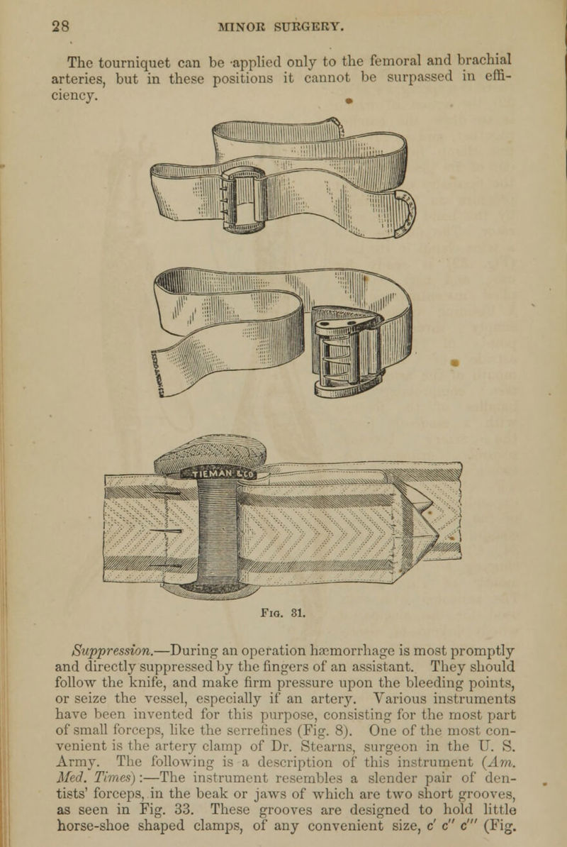 The tourniquet can be -applied only to the femoral and brachial arteries, but in these positions it cannot be surpassed in effi- ciency. m Fio. 81. Suppression.—During an operation haemorrhage is most promptly and directly suppressed by the fingers of an assistant. They should follow the knife, and make firm pressure upon the bleeding points, or seize the vessel, especially if an artery. Various instruments have been invented for this purpose, consisting for the most part of small forceps, like the serrefines (Fig. 8). One of the most con- venient is the artery clamp of Dr. Stearns, surgeon in the U. S. Army. The following is a description of this instrument (Am. Med. Timest:—The instrument resembles a slender pair of den- tists' forceps, in the beak or jaws of which arc two short grooves, as seen in Fig. 33. These grooves are designed to hold little horse-shoe shaped clamps, of any convenient size, c' c c' (Fig.
