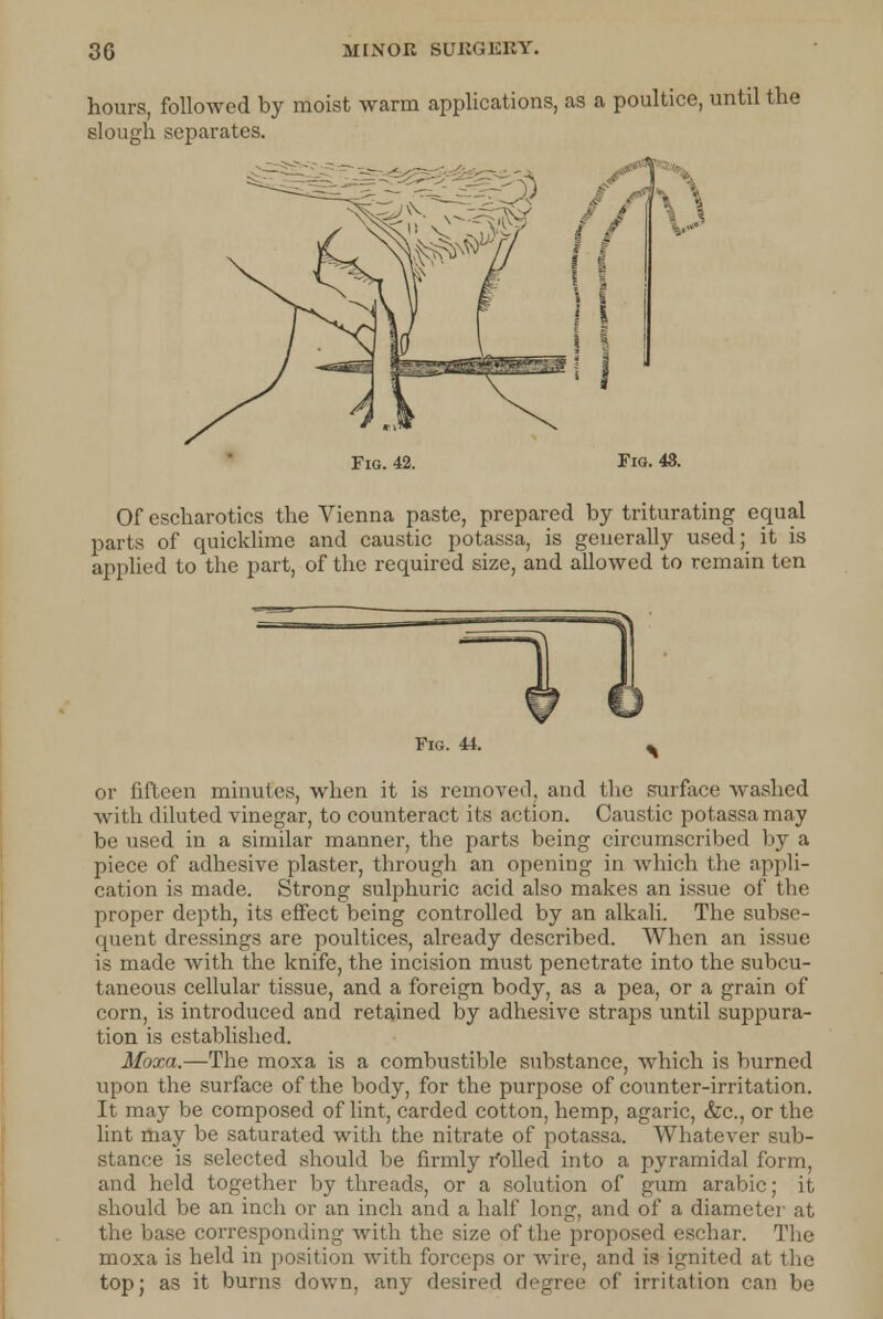 hours, followed by moist warm applications, as a poultice, until the slough separates. Fig. 42. Fig. 43. Of escharotics the Vienna paste, prepared by triturating equal parts of quicklime and caustic potassa, is generally used; it is applied to the part, of the required size, and allowed to remain ten Fig. 44. ^ or fifteen minutes, when it is removed, and the surface washed with diluted vinegar, to counteract its action. Caustic potassa may be used in a similar manner, the parts being circumscribed by a piece of adhesive plaster, through an opening in which the appli- cation is made. Strong suhphuric acid also makes an issue of the proper depth, its effect being controlled by an alkali. The subse- quent dressings are poultices, already described. When an issue is made with the knife, the incision must penetrate into the subcu- taneous cellular tissue, and a foreign body, as a pea, or a grain of corn, is introduced and retained by adhesive straps until suppura- tion is established. Moxa.—The moxa is a combustible substance, which is burned upon the surface of the body, for the purpose of counter-irritation. It may be composed of lint, carded cotton, hemp, agaric, &c, or the lint may be saturated with the nitrate of potassa. Whatever sub- stance is selected should be firmly rolled into a pyramidal form, and held together by threads, or a solution of gum arabic; it should be an incli or an inch and a half long, and of a diameter at the base corresponding with the size of the proposed eschar. The moxa is held in position with forceps or wire, and is ignited at the top; as it burns down, any desired degree of irritation can be