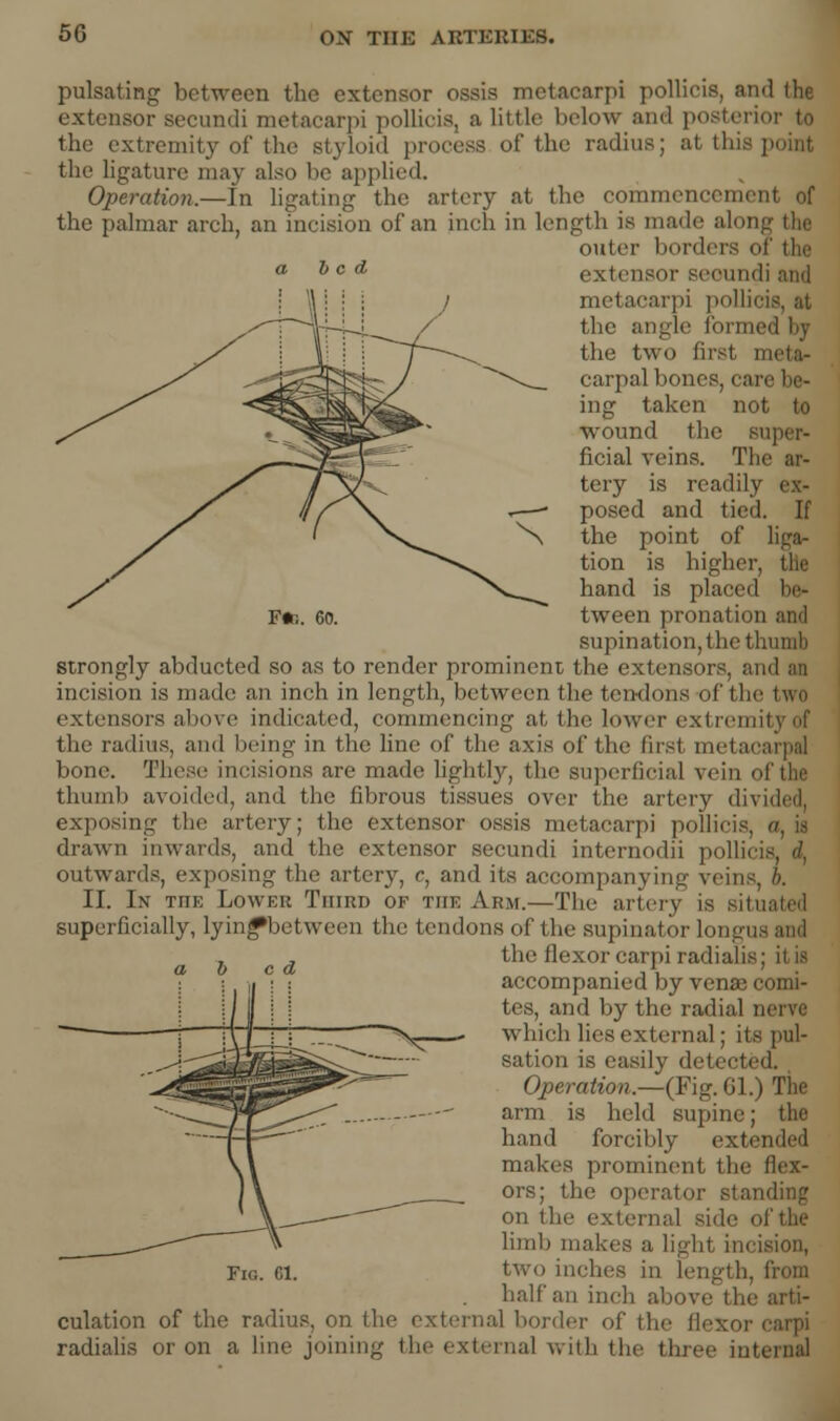 F«R. 60. pulsating between the extensor ossis metacarpi pollicis, and the extensor secundi metacarpi pollicis, a little below and posterior to the extremity of the styloid process of the radius; at this point the ligature may also be applied. Operation.—In ligating the artery at the commcnccm the palmar arch, an incision of an inch in length is made along the outer borders of the extensor secundi and carpi pollicis, at the angle formed by the two fii carpal bones, care be- ing taken not to wound the super- ficial veins. The ar- tery is readily ex- posed and tied. If the point of liga- tion is higher, the hand is placed be- tween pronation and supination, the thumb strongly abducted so as to render prominent the extensors, am incision is made an inch in length, between the ten-dons of the extensors above indicated, commencing at, the lower extremit the radius, and being in the line of the axis (if the first metacarpal bone. These incisions are made lightly, the superficial vein of the thumb avoided, and the fibrous tissues over the artery divided, exposing the artery; the extensor ossis metacarpi pollicis. drawn inwards, and the extensor secundi internodii pollic outwards, exposing the artery, c, and its accompanying veins, h. II. In toe Lower Third of the Arm.—The artery is superficially, lyin^botween the tendons of the supinator longui the flexor carpi radialis; it is accompanied by venae comi- tes, and by the radial nerve which lies external; its pul- sation is easily detected. Operation.—(Fig. Gl.) The arm is held supine; the hand forcibly exti makes prominent the flex- ors; the operator standing on the externa] side of the limb makes a light incision, Fig. 61. two inches in length, from half an inch above the arti- culation of the radius, on the external border of the flexor i radialis or on a line joining the external with the three internal