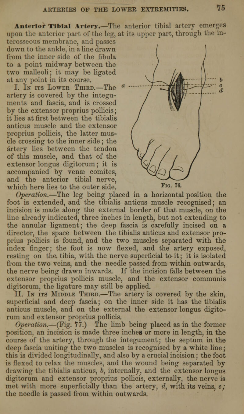 Fig. 76. Anterior Tibial Artery.—The anterior tibial artery emerges upon the anterior part of the leg, at its upper part, through the in- terosseous membrane, and passes down to the ankle, in a line drawn from the inner side of the fibula to a point midway between the two malleoli; it may be ligated at any point in its course. I. In its Lower Third.—The artery is covered by the integu- ments and fascia, and is crossed by the extensor proprius pollicis; it lies at first between the tibialis anticus muscle and the extensor proprius pollicis, the latter mus- cle crossing to the inner side ; the artery lies between the tendon of this muscle, and that of the extensor longus digitorum; it is accompanied by venae comites, and the anterior tibial nerve, which here lies to the outer side. Operation.—The leg being placed in a horizontal position the foot is extended, and the tibialis anticus muscle recognised; an incision is made along the external border of that muscle, on the fine already indicated, three inches in length, but not extending to the annular ligament; the deep fascia is carefully incised on a director, the space between the tibialis anticus and extensor pro- prius pollicis is found, and the two muscles separated with the index finger; the foot is now flexed, and the artery exposed, resting on tha tibia, with the nerve superficial to- it; it is isolated from the two veins, and the needle passed from within outwards, the nerve being drawn inwards. If the incision falls between the extensor proprius pollicis muscle, and the extensor communis digitorum, the ligature may still be applied. II. In its Middle Third.—The artery is covered by the skin, superficial and deep fascia; on the inner side it has the tibialis anticus muscle, and on the external the extensor longus digito- rum and extensor proprius pollicis. Operation.—(Fig. 77.) The limb being placed as in the former position, an incision is made three inches or more in length, in the course of the artery, through the integument; the septum in the deep fascia uniting the two muscles is recognised by a white line; this is divided longitudinally, and also by a crucial incision; the foot is flexed to relax the muscles, and the wound being separated by drawing the tibialis anticus, b, internally, and the extensor longus digitorum and extensor proprius pollicis, externally, the nerve is met with more superficially than the artery, d, with its veins, c; the needle is passed from within outwards.