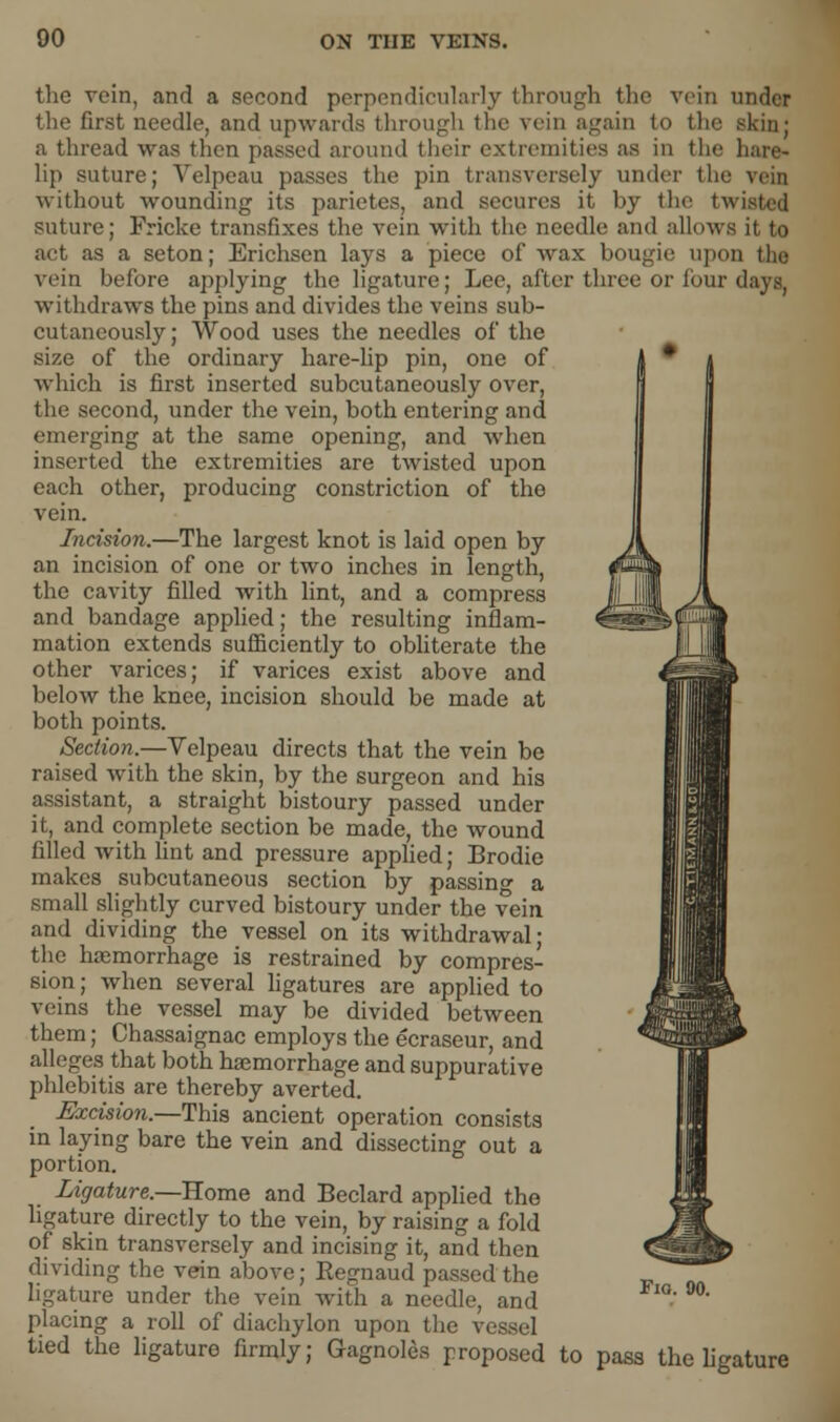 the rein, and a second perpendicularly through the vein under the first needle, and upwards through the vein again to the skin; a thread was then passed around their extremities as in the hare- lip suture; Velpeau passes the pin transversely under the vein without wounding its parietes, and secures it by the twisted suture; Fricke transfixes the vein with the needle and allows it to act as a seton; Erichsen lays a piece of wax bougie upon the vein before applying the ligature; Lee, alter three or four days, withdraws the pins and divides the veins sub- cutaneously; Wood uses the needles of the size of the ordinary hare-lip pin, one of which is first inserted subcutaneously over, the second, under the vein, both entering and emerging at the same opening, and when inserted the extremities are twisted upon each other, producing constriction of the vein. Incision.—The largest knot is laid open by an incision of one or two inches in length, the cavity filled with lint, and a compress and bandage applied; the resulting inflam- mation extends sufficiently to obliterate the other varices; if varices exist above and below the knee, incision should be made at both points. Section.—Velpeau directs that the vein be raised with the skin, by the surgeon and his assistant, a straight bistoury passed under it, and complete section be made, the wound filled with lint and pressure applied; Brodie makes subcutaneous section by passing a small slightly curved bistoury under the vein and dividing the vessel on its withdrawal; the haemorrhage is restrained by compres- sion; when several ligatures are applied to veins the vessel may be divided between them; Chassaignac employs the ecraseur, and alleges that both haemorrhage and suppurative phlebitis are thereby averted. Excision.—This ancient operation consists in laying bare the vein and dissecting out a portion. Ligature.—Home and Beclard applied the ligature directly to the vein, by raising a fold of skin transversely and incising it, and then dividing the vein above; Eegnaud passed the ligature under the vein with a needle, and placing a roll of diachylon upon the vessel tied the ligature firmly; Gagnoles proposed to pass the ligature
