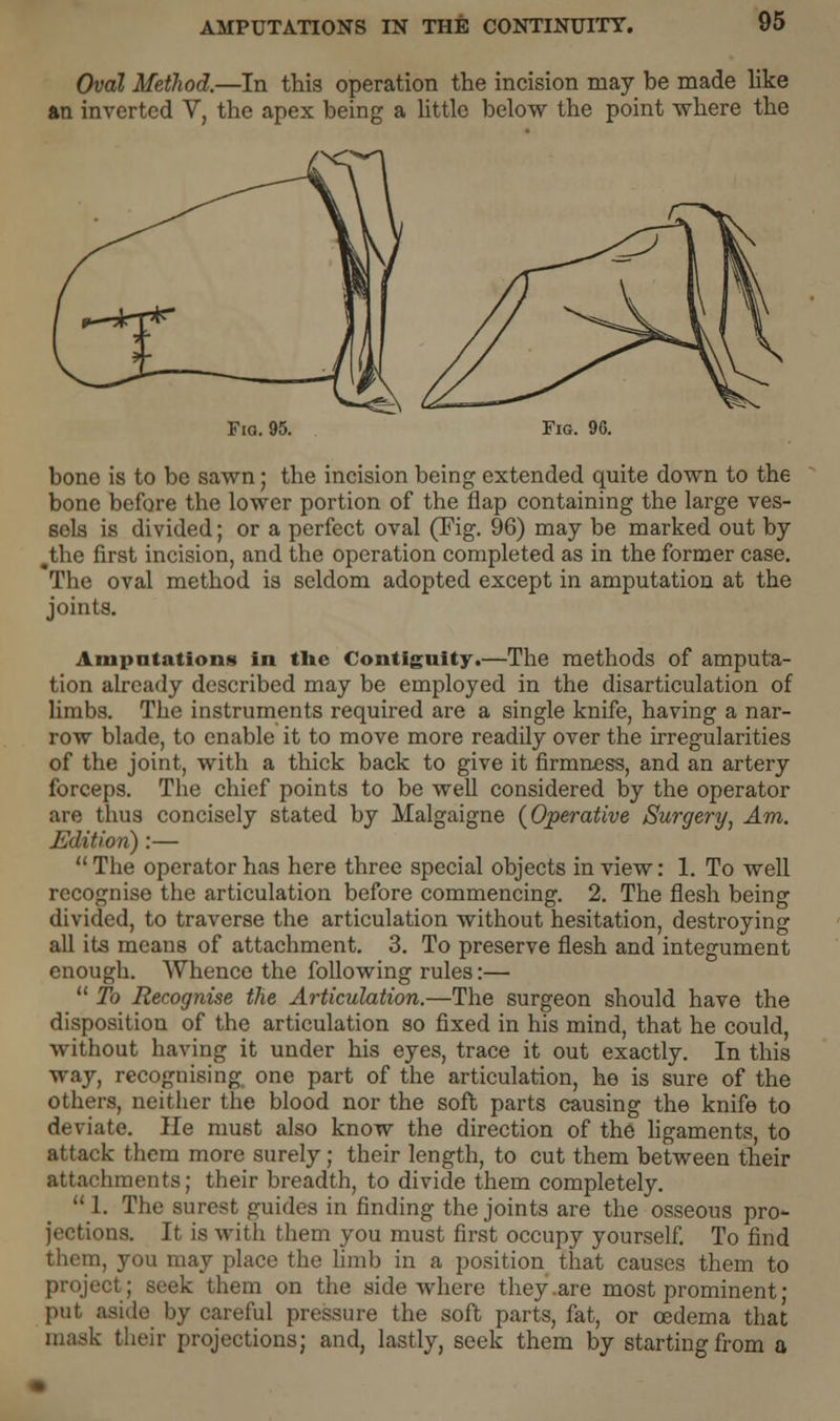 Oval Method.—In this operation the incision may be made like an inverted V, the apex being a little below the point where the Fig. 95. Fig. 9G. bone is to be sawn; the incision being extended quite down to the bone before the lower portion of the flap containing the large ves- sels is divided; or a perfect oval (Tig. 96) may be marked out by ^the first incision, and the operation completed as in the former case. The oval method is seldom adopted except in amputation at the joints. Amputation* in the Contiguity.—The methods of amputa- tion already described may be employed in the disarticulation of limbs. The instruments required are a single knife, having a nar- row blade, to enable it to move more readily over the irregularities of the joint, with a thick back to give it firmness, and an artery forceps. The chief points to be well considered by the operator are thus concisely stated by Malgaigne (Operative Surgery, Am. Edition) :— The operator has here three special objects in view: 1. To well recognise the articulation before commencing. 2. The flesh being divided, to traverse the articulation without hesitation, destroying all its means of attachment. 3. To preserve flesh and integument enough. Whence the following rules:— To Recognise the Articulation.—The surgeon should have the disposition of the articulation so fixed in his mind, that he could, without having it under his eyes, trace it out exactly. In this way, recognising one part of the articulation, he is sure of the others, neither the blood nor the soft parts causing the knife to deviate. He mu6t also know the direction of the ligaments, to attack them more surely; their length, to cut them between their attachments; their breadth, to divide them completely. 1. The surest guides in finding the joints are the osseous pro- jections. It is with them you must first occupy yourself. To find them, you may place the limb in a position that causes them to project; seek them on the side where they are most prominent ■ put aside by careful pressure the soft parts, fat, or oedema that mask their projections; and, lastly, seek them by starting from a