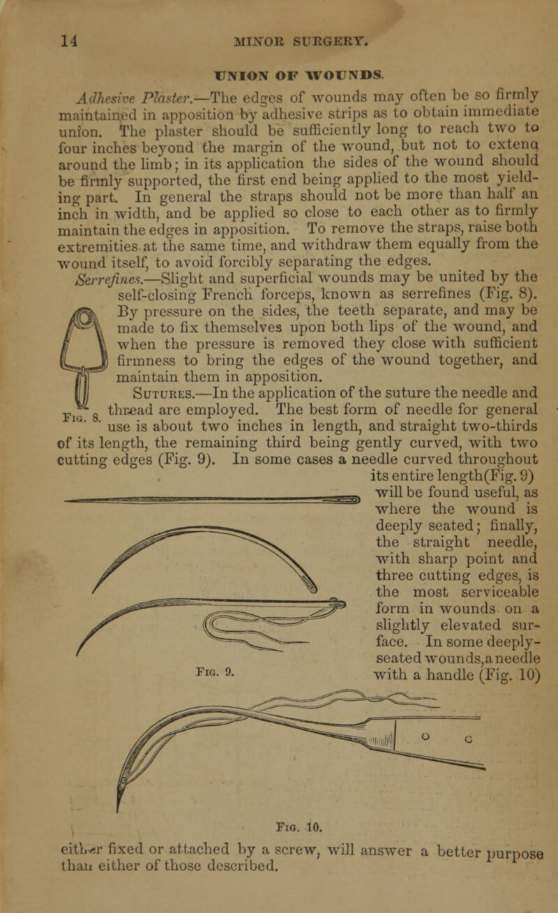 UNION OF WOUNDS. Ptoster.—The edges of wounds may often be so firmly maintained in apposition by adhesive strips as to obtain immei union. The plaster should be sufficiently long to reach two to four inches beyond the margin of the wound, but not to extend around the limb; in its application the sides of the wound should be firmly supported, the first end being applied to the most yield- ing part. In general the straps should not be more than half an inch in width, and be applied so close to each other as to firmly maintain the edges in apposition. To remove the straps, raise both extremities at the same time, and withdraw them equally from the wound itself, to avoid forcibly separating the edges. Serrefines.—Slight and superficial wounds may be united by the self-closing French forceps, known as serrefines (Fig. 8). By pressure on the sides, the teeth separate, and may be made to fix themselves upon both lips of the wound, and when the pressure is removed they close with sufficient firmness to bring the edges of the wound together, and maintain them in apposition. Sutures.—In the application of the suture the needle and thread are employed. The best form of needle for general ' use is about two inches in length, and straight two-thirds of its length, the remaining third being gently curved, with two cutting edges (Fig. 9). In some cases a needle curved throughout its entire length(Fig. 9) will be found useful, as where the wound is deeply seated; finally, the straight needle, with sharp point and three cutting edges, is the most serviceable form in wounds on a slightly elevated sur- face. In some deeply- seated wounds,a needle with a handle (Fig. 10) --^J-rt> Fig. 10. either fixed or attached by a screw, will answer a better purpose than either of those described.