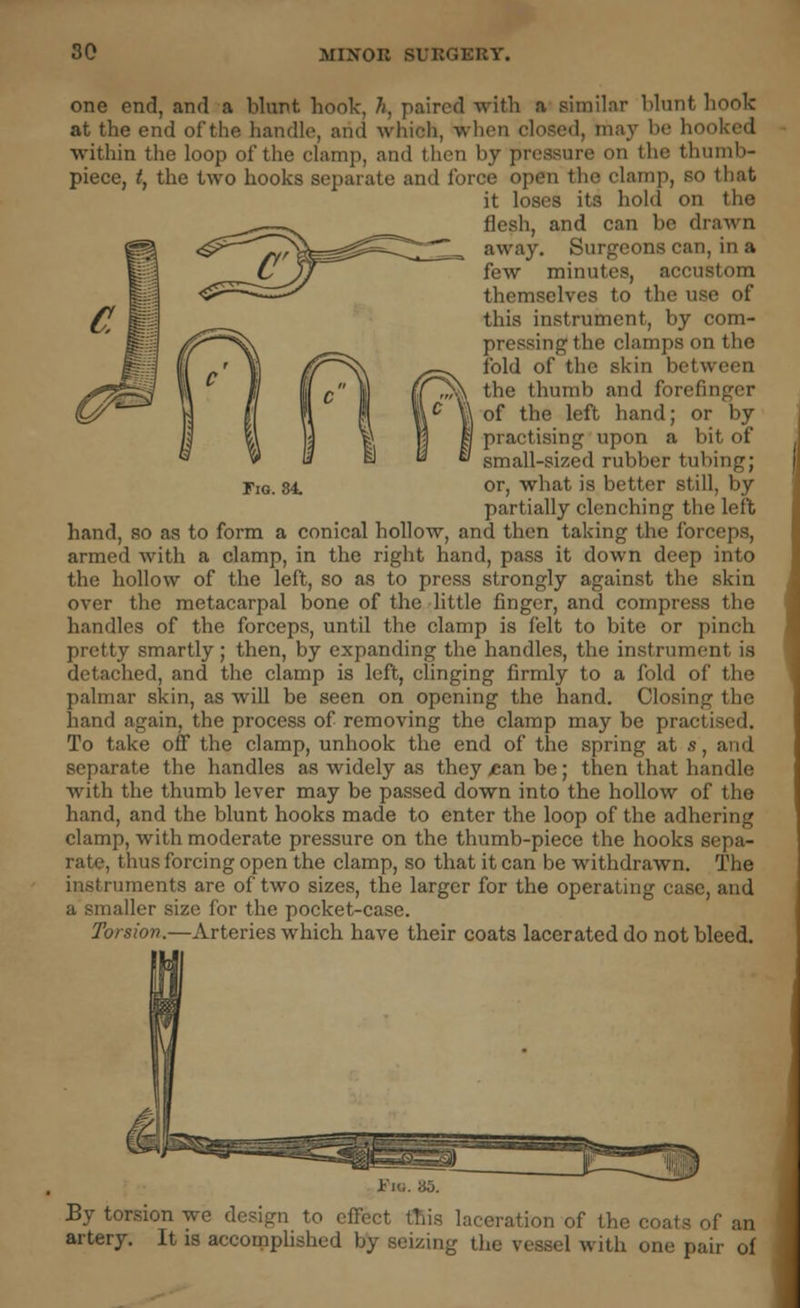 Tig. 84 one end, and a blunt, hook, h, paired with a similar blunt hook at the end of the handle, and whioh, when closed, may be hooked within the loop of the clamp, and then by pressure on the thumb- piece, t, the two hooks separate and force open the clamp, so that it loses its hold on the flesh, and can be drawn away. Surgeons can, in a few minutes, accn themselves to the use of this instrument, by com- pressing the clamps on the fold of the skin between the thumb and forefinger of the left hand; or by practising upon a bit of small-sized rubber tubing; or, what is better still, by partially clenching the left hand, so as to form a conical hollow, and then taking the forceps, armed with a clamp, in the right hand, pass it down deep into the hollow of the left, so as to press strongly against the skin over the metacarpal bone of the little finger, and compress the handles of the forceps, until the clamp is felt to bite or pinch pretty smartly; then, by expanding the handles, the instrument is detached, and the clamp is left, clinging firmly to a fold of the palmar skin, as will be seen on opening the hand. Closing the hand again, the process of removing the clamp may be practised. To take off the clamp, unhook the end of the spring at s, and separate the handles as widely as they >ean be; then that handle with the thumb lever may be passed down into the hollow of the hand, and the blunt hooks made to enter the loop of the adhering clamp, with moderate pressure on the thumb-piece the hooks sepa- rate, thus forcing open the clamp, so that it can be withdrawn. The instruments are of two sizes, the larger for the operating case, and a smaller size for the pocket-case. Torsion.—Arteries which have their coats lacerated do not bleed. i'i<i. a5. By torsion we design to effect this laceration of the coa artery. It is accomplished by seizing the vessel with one pair o